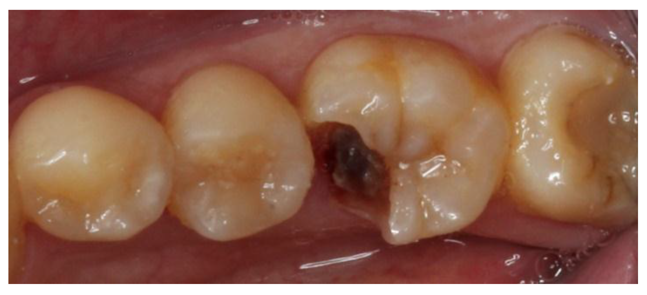 cavity side of molar