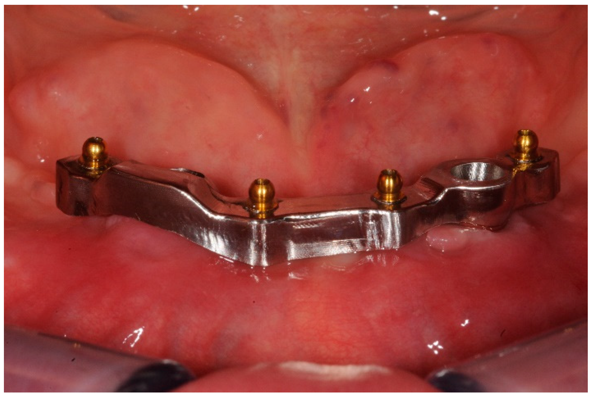 Rhein'83 On X Implant Supported Bar With Ot Bar