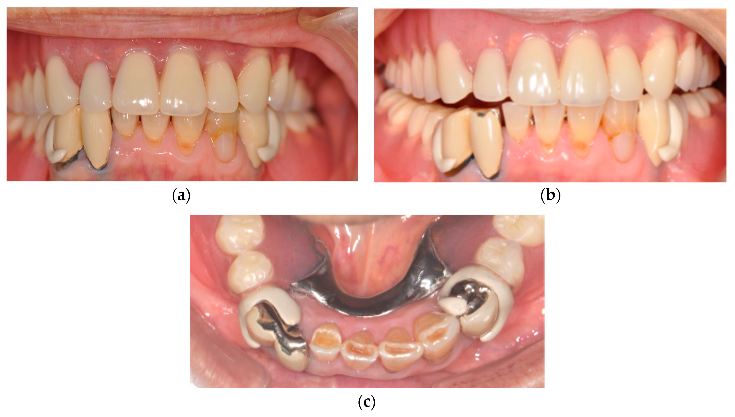 Bolt Attachment changes Partial Denture Prosthodontics - Suginaka “Riegel Bolt Attachment changes Partial Denture Prosthodontics