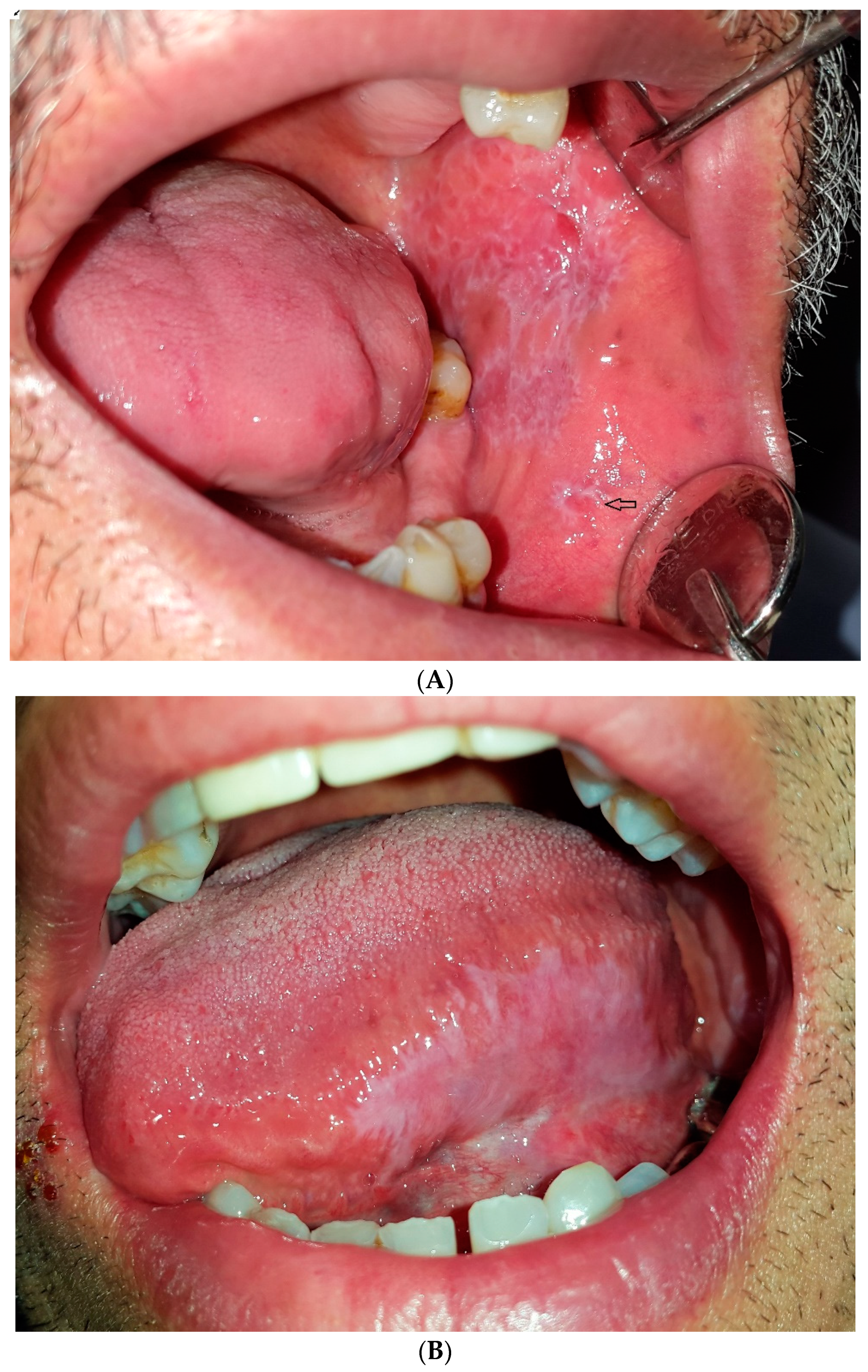 florid papillomatosis mouth