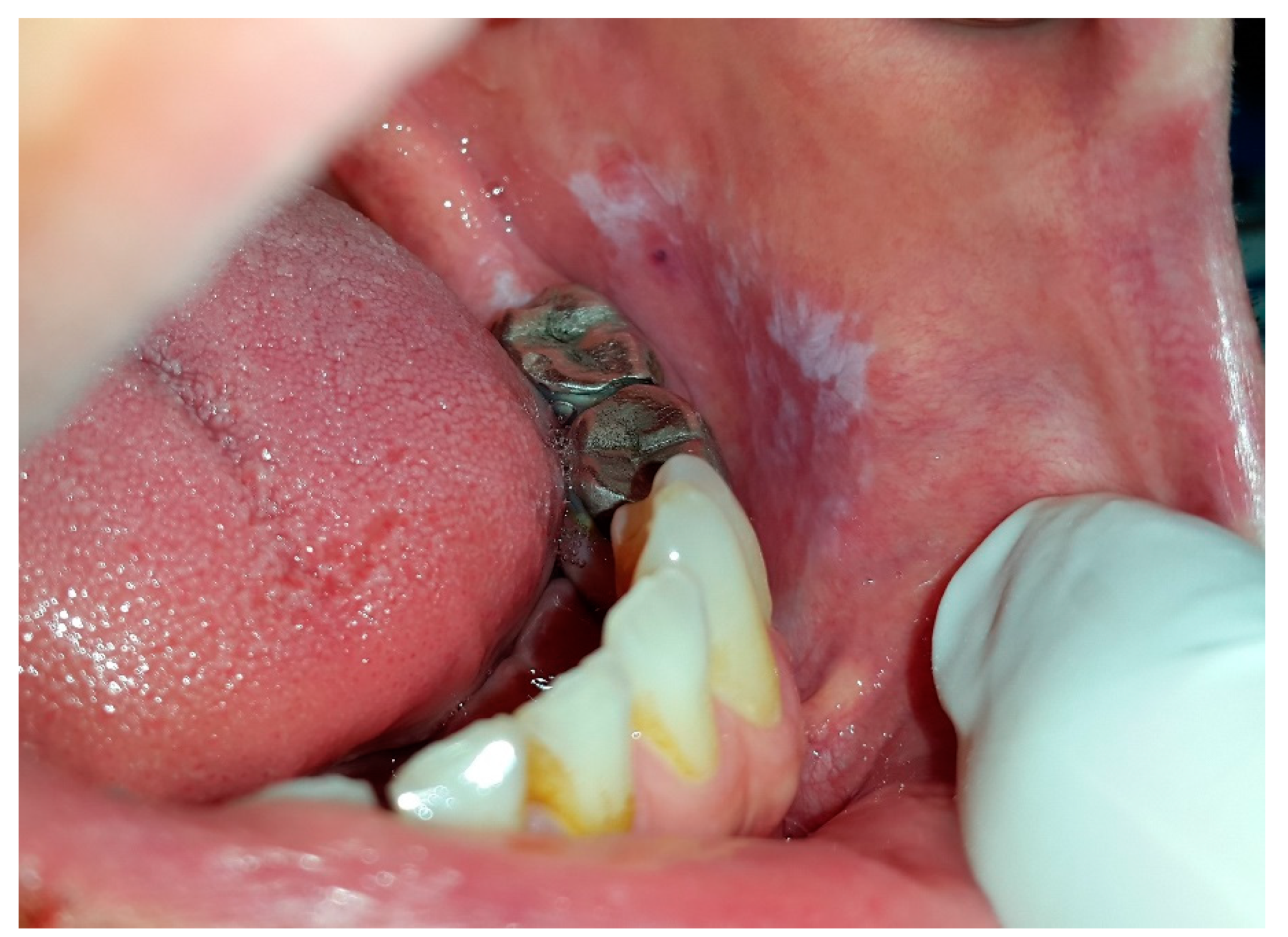 Dentistry Journal Free Full Text Oral White Lesions An