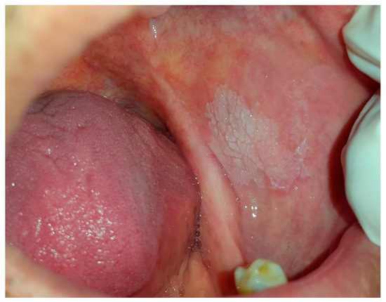 Oral White Lesions: An Updated Clinical Diagnostic Decision Tree