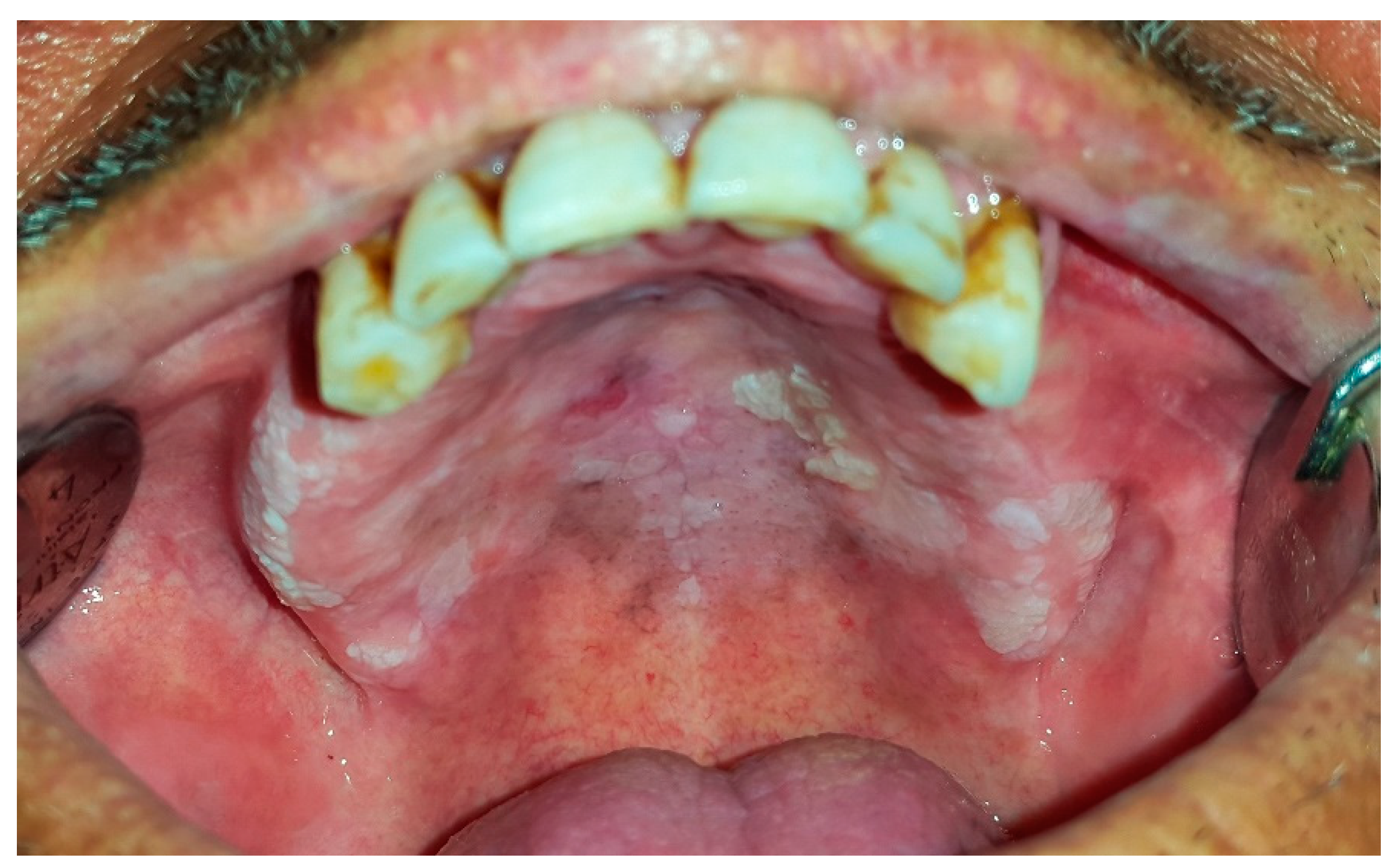 Dentistry Journal Free Full Text Oral White Lesions An