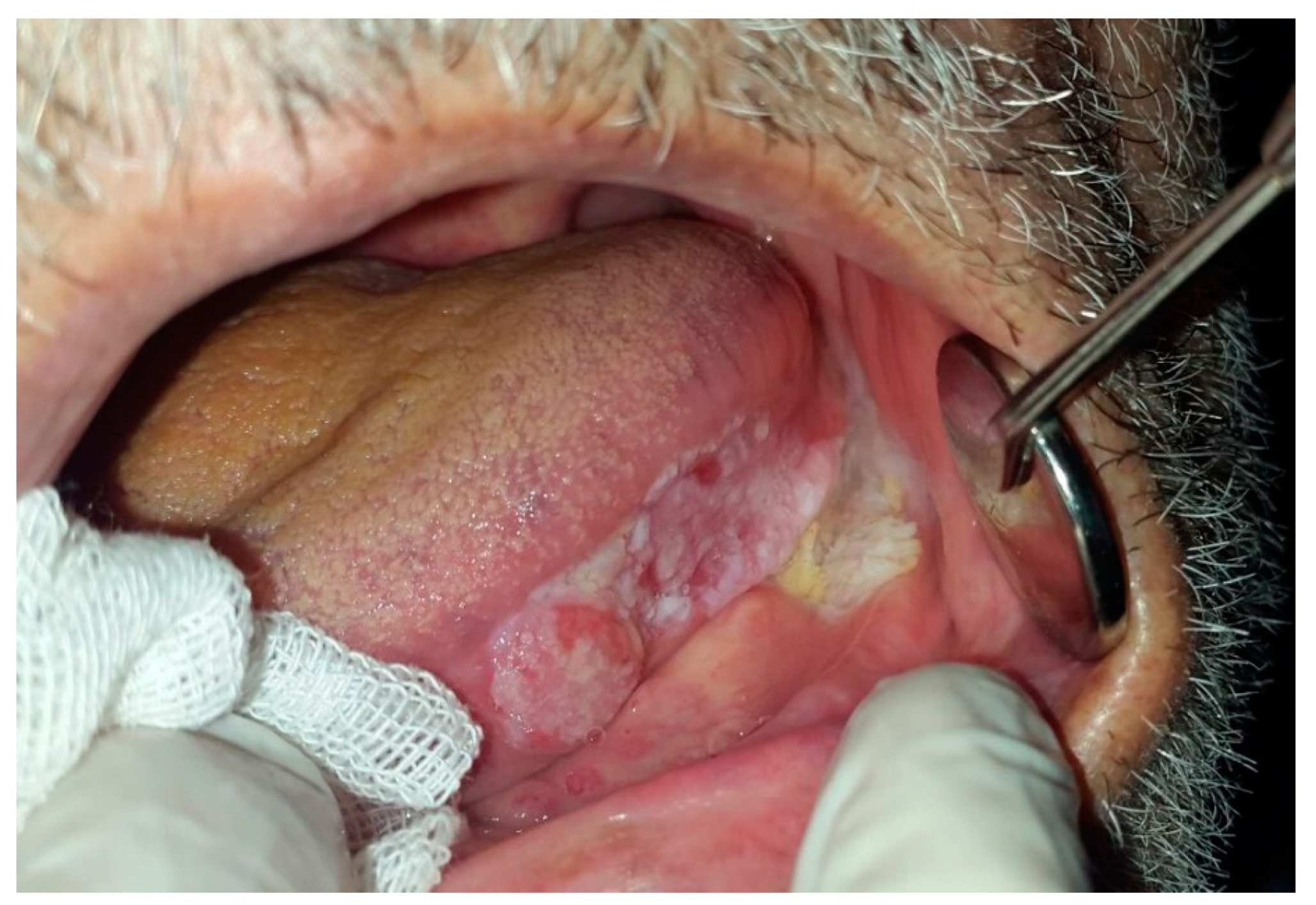 Dentistry Journal Free Full Text Oral White Lesions An