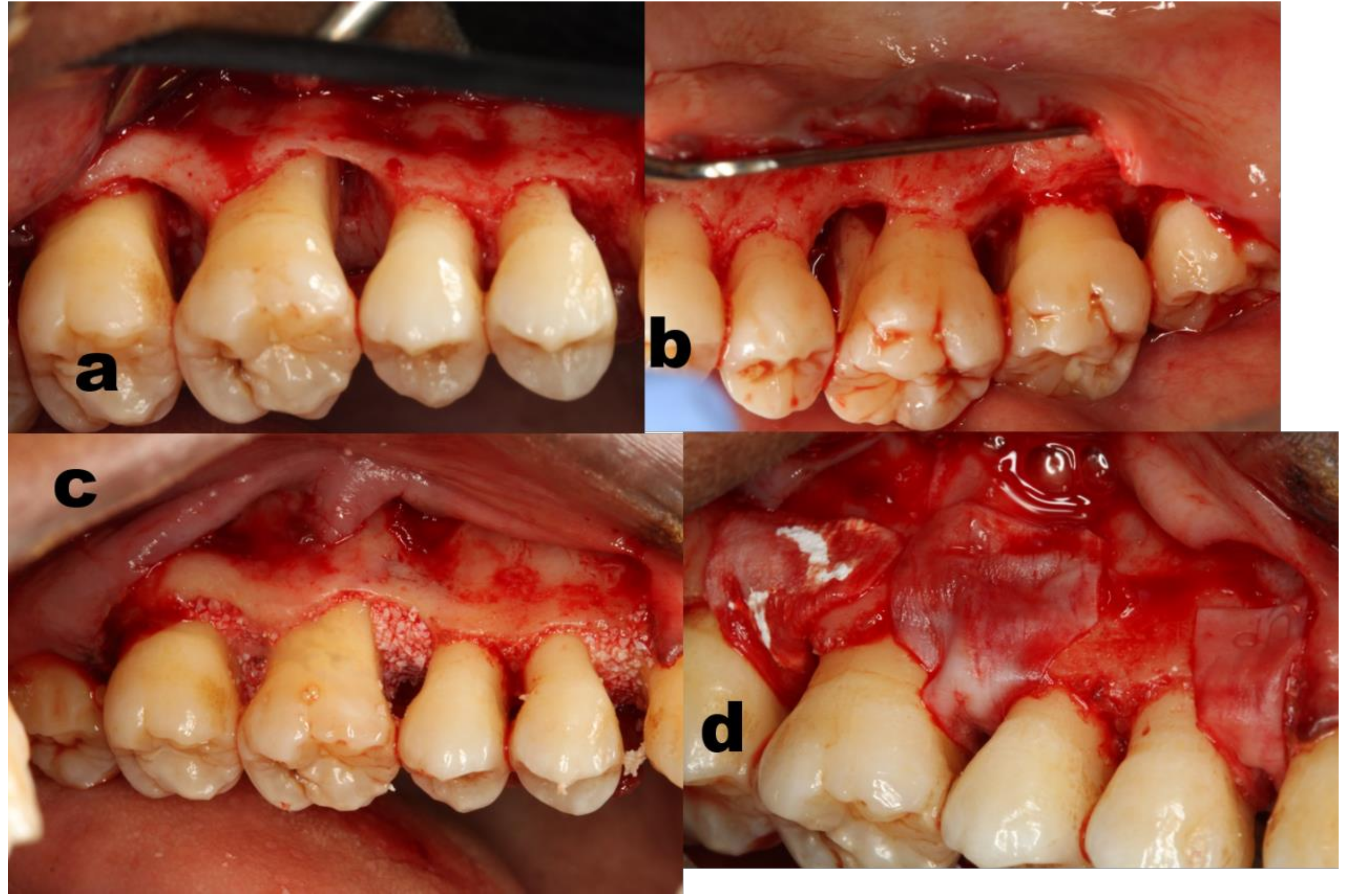 Se puede salvar un diente con periodontitis