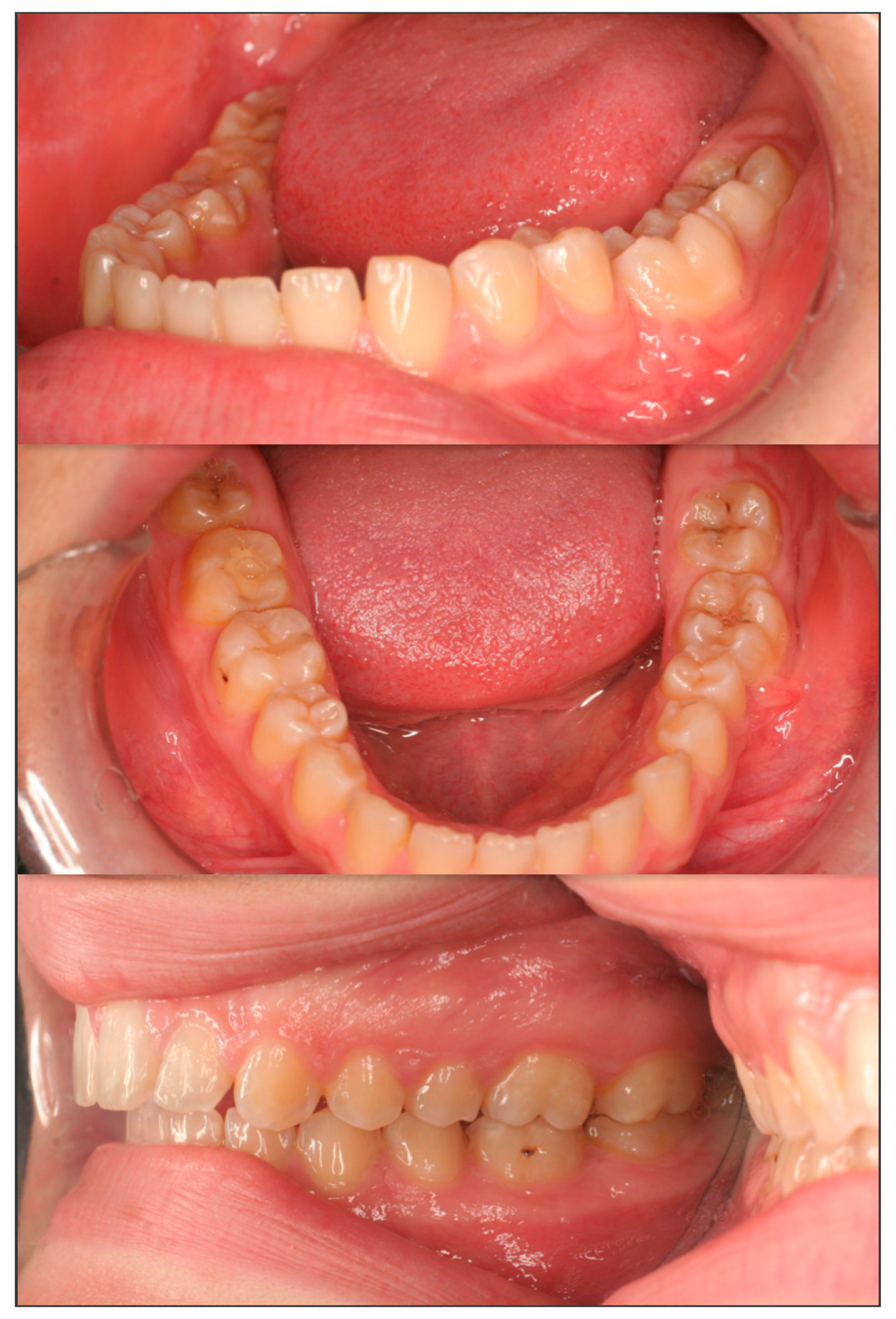 Dentistry Journal | Free Full-Text | Uprighting an Impacted Permanent