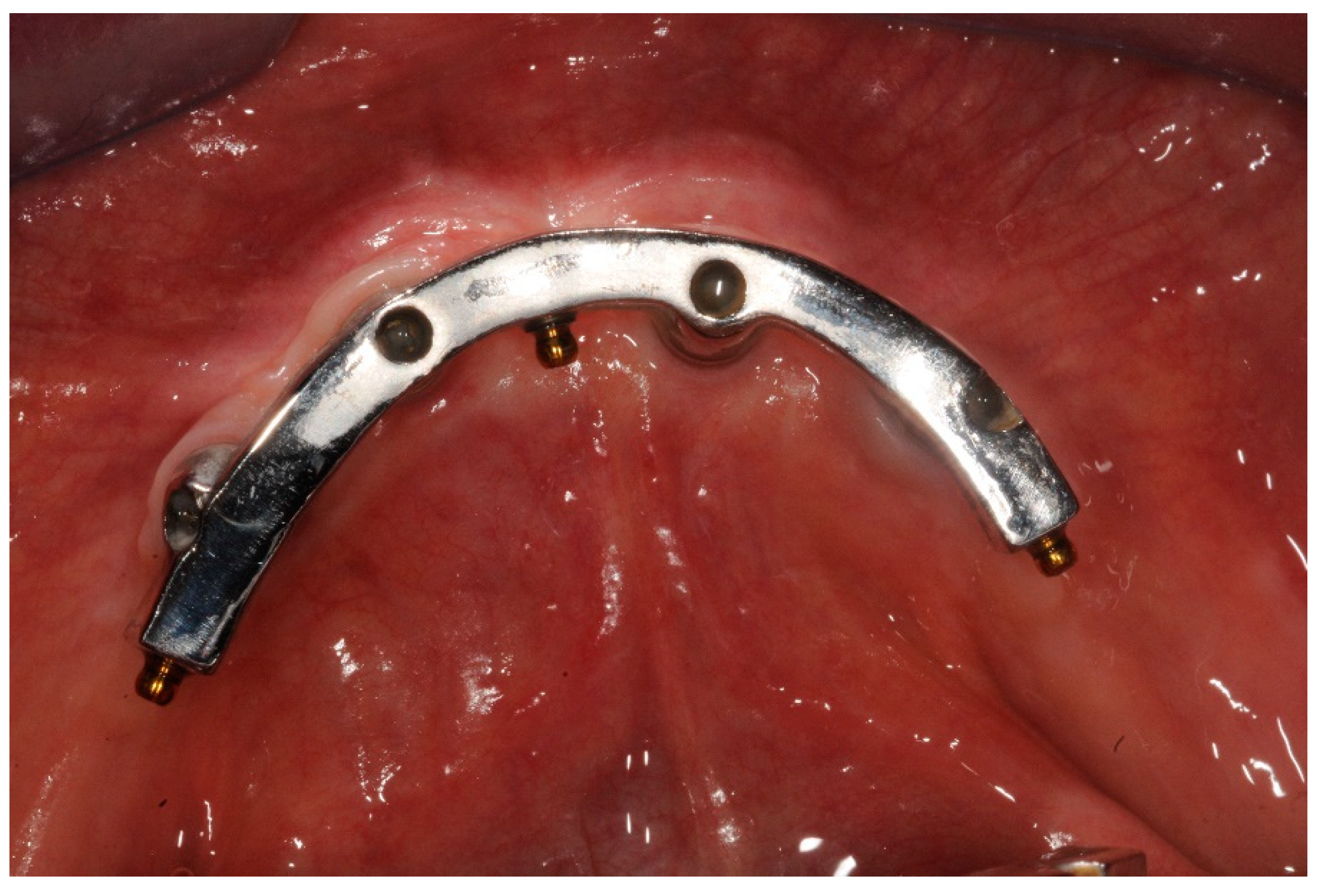 Dentistry Journal Free FullText Effectiveness of Ball Attachment