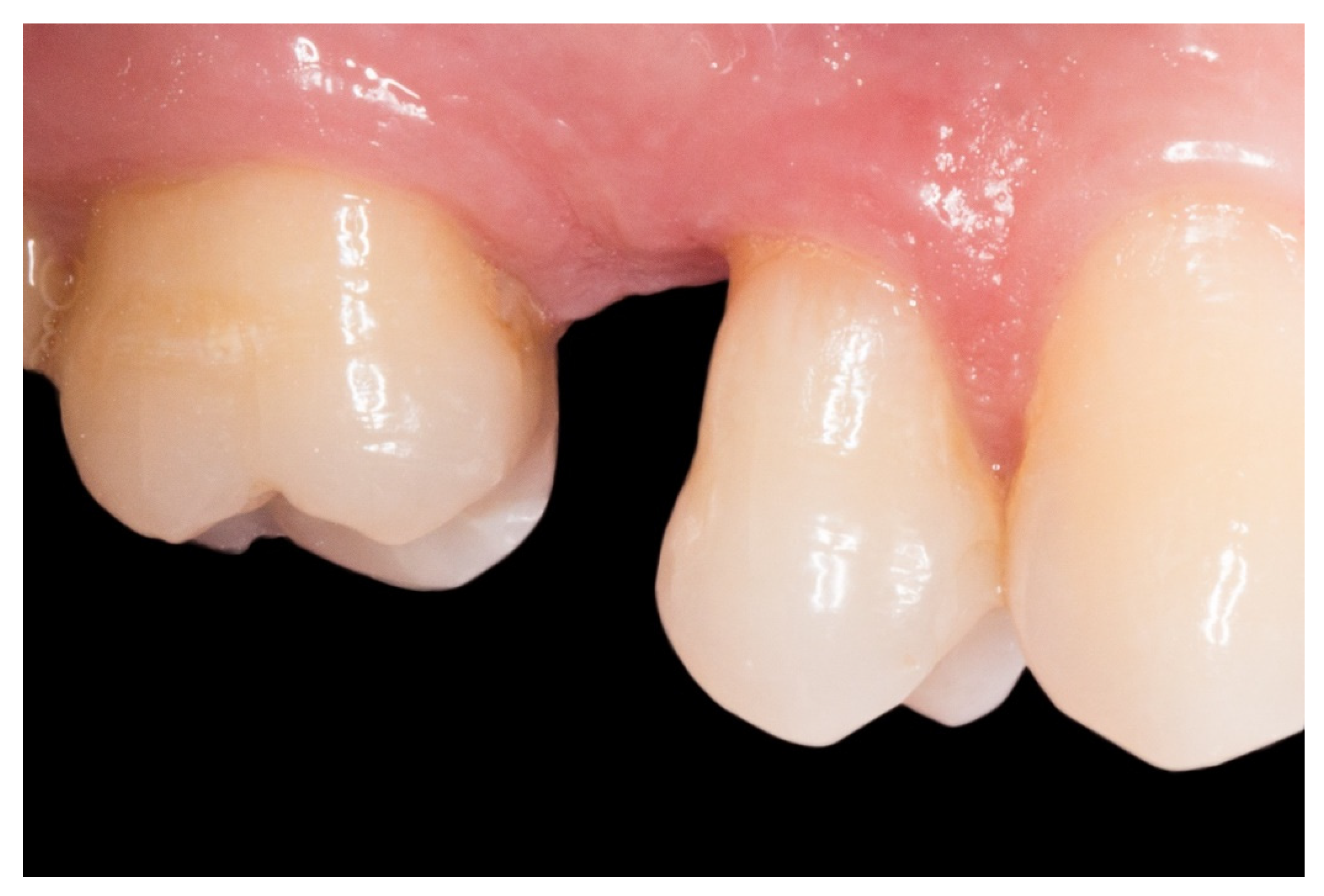 Lake Titicaca Incubus Looting Dentistry Journal | Free Full-Text | A New Technique for Direct Fabrication of Fiber-Reinforced Composite Bridge: A Long-Term Clinical Observation | HTML Lake Titicaca Incubus Looting Dentistry Journal | Free Full-Text | A New Technique for Direct Fabrication of Fiber-Reinforced Composite Bridge: A Long-Term Clinical Observation | HTML