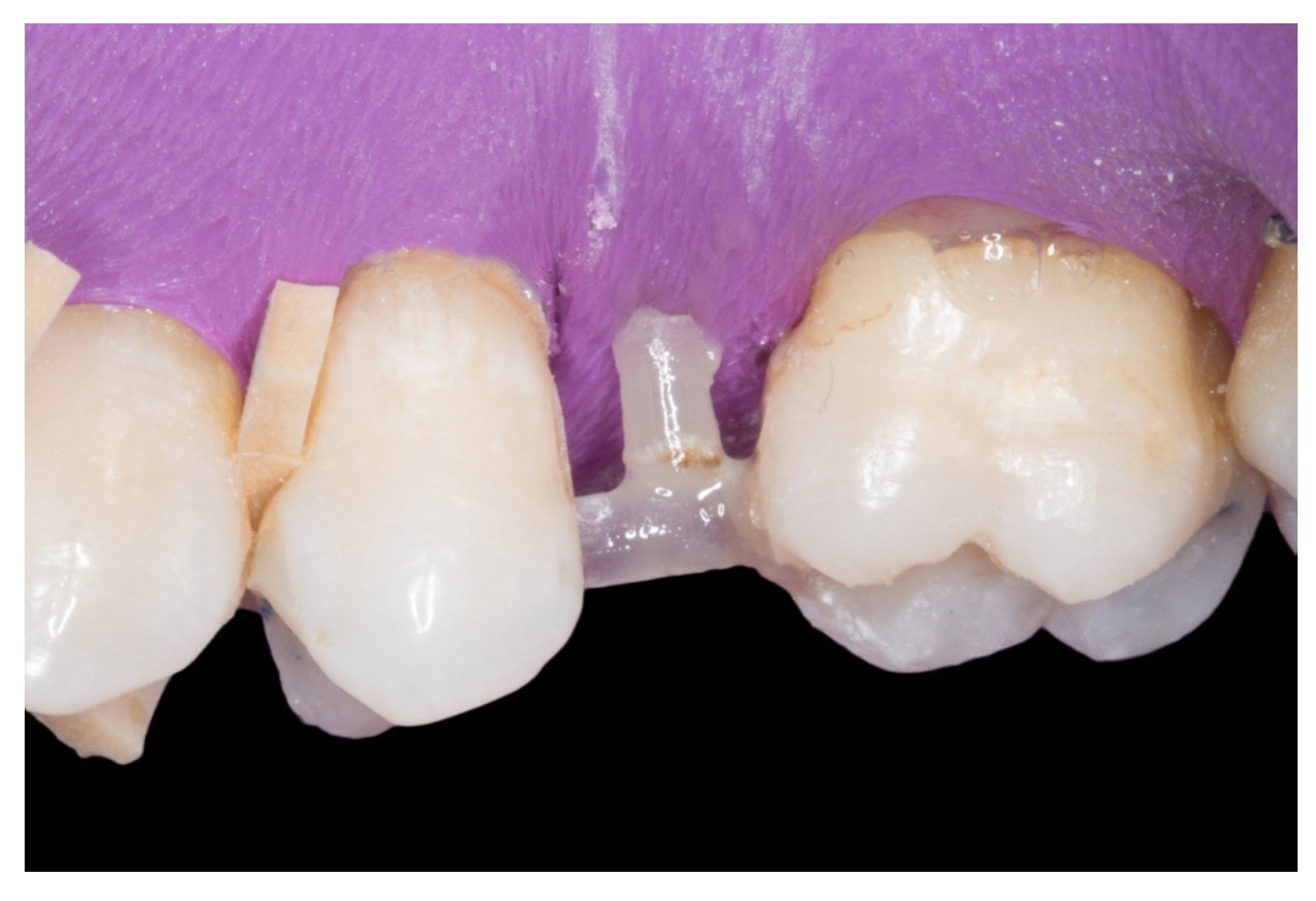 Dentistry Journal | Free Full-Text | A New Technique for Direct