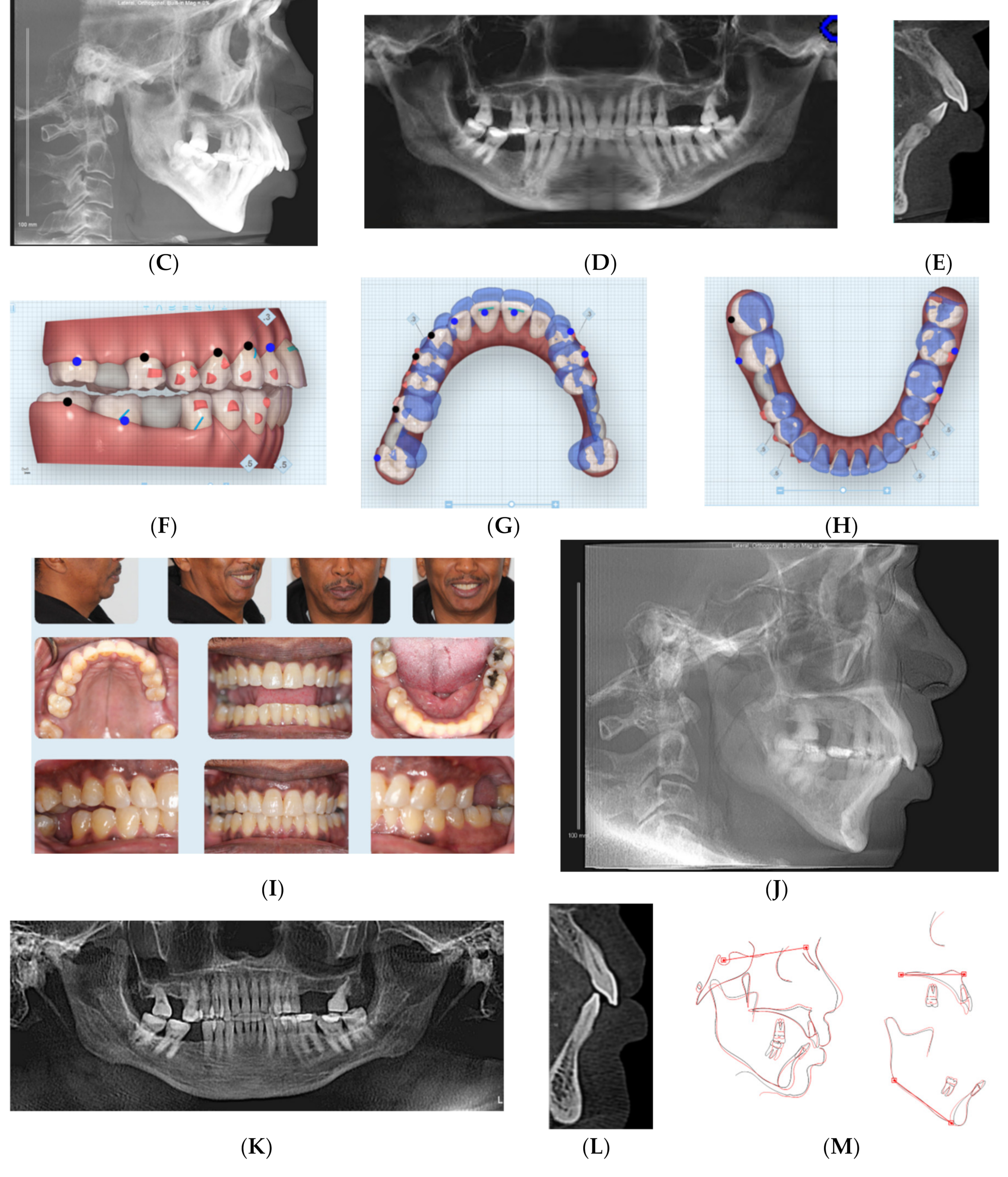 PDF) Changes in the anterior and posterior occlusal plane in nongrowing  females with hyperdivergent skeletal Class II malocclusion treated with mini-implant  anchorage