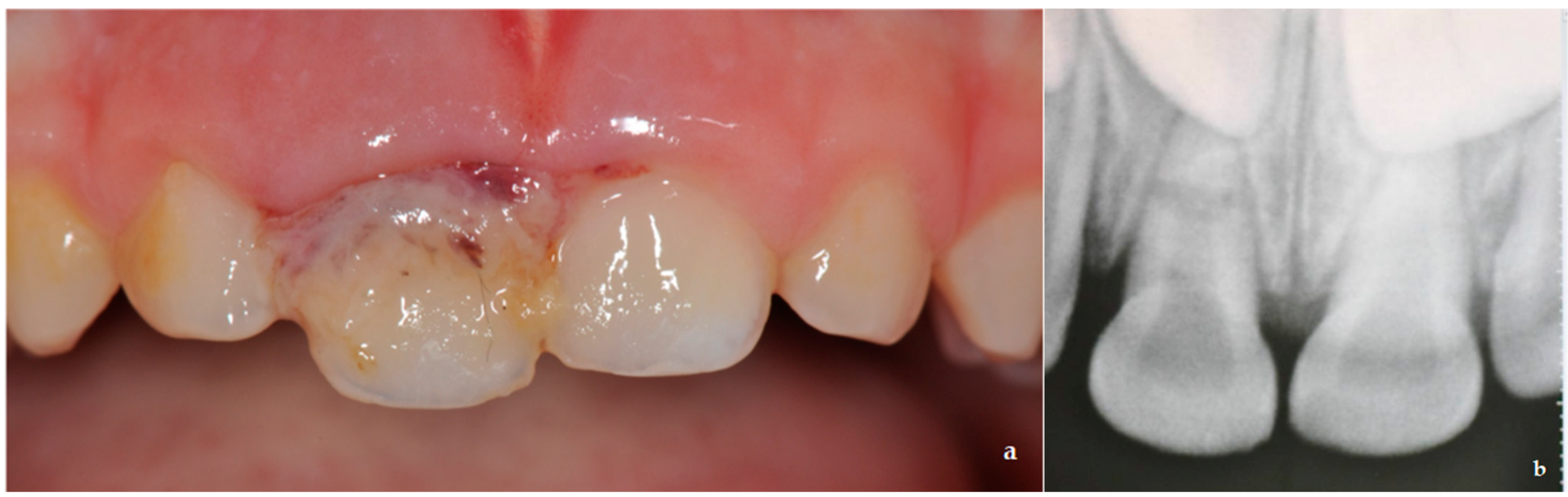 Dentistry Journal Free FullText Root Fracture and Extrusive