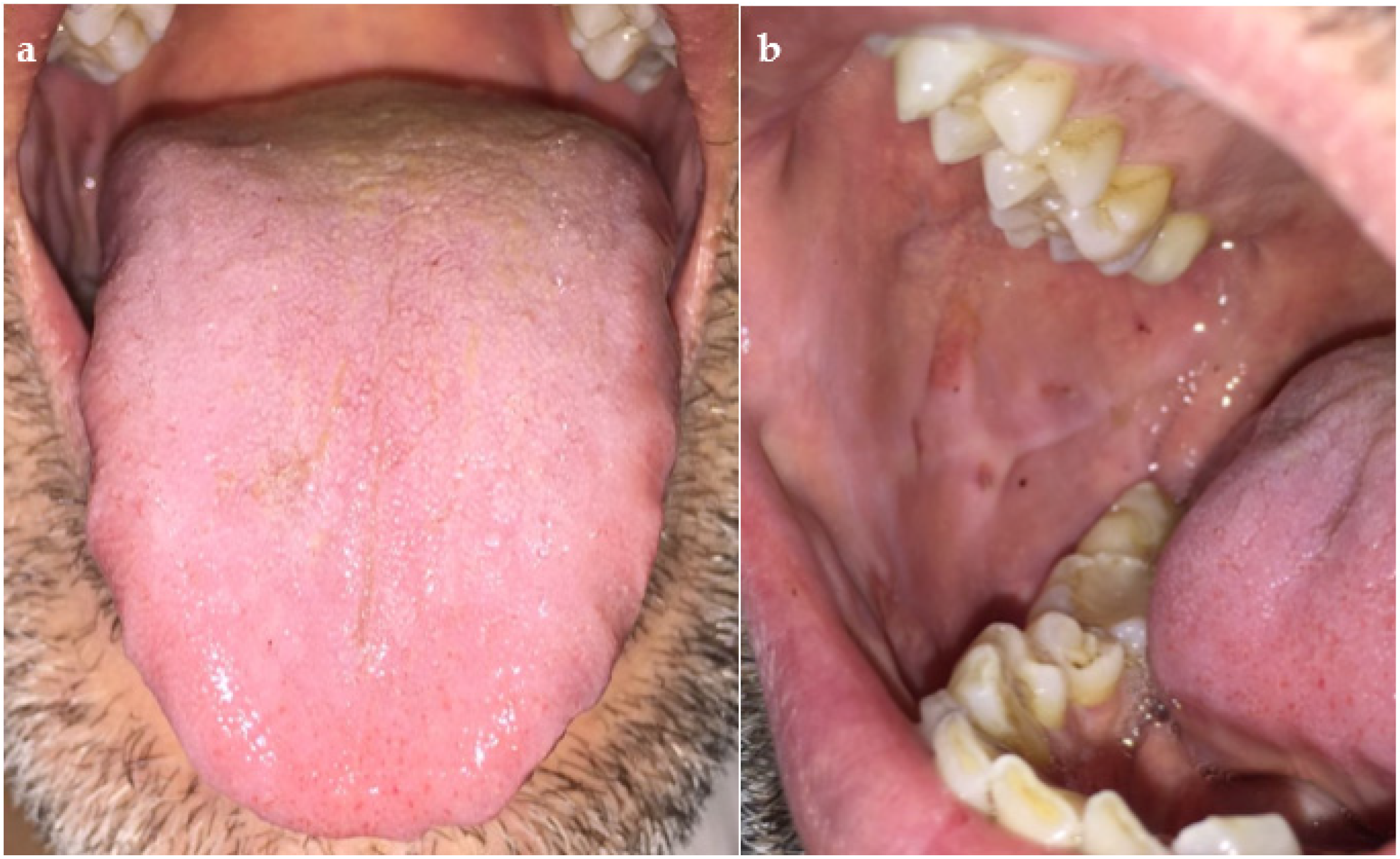 Dentistry Journal | Free Full-Text | Oral Healthcare and Idiopathic  Thrombocytopenic Purpura: Early Recognition, Dental Management and Case  Report