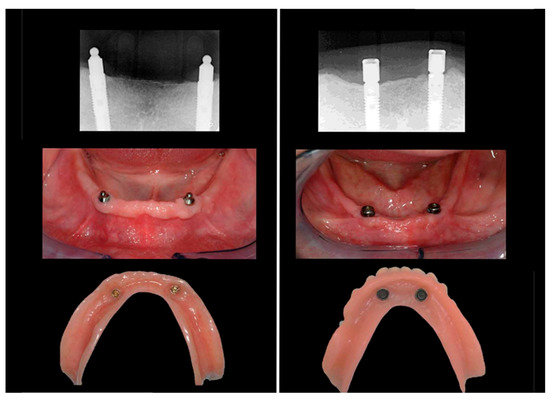 File:Mandibula 1.jpg - Wikimedia Commons