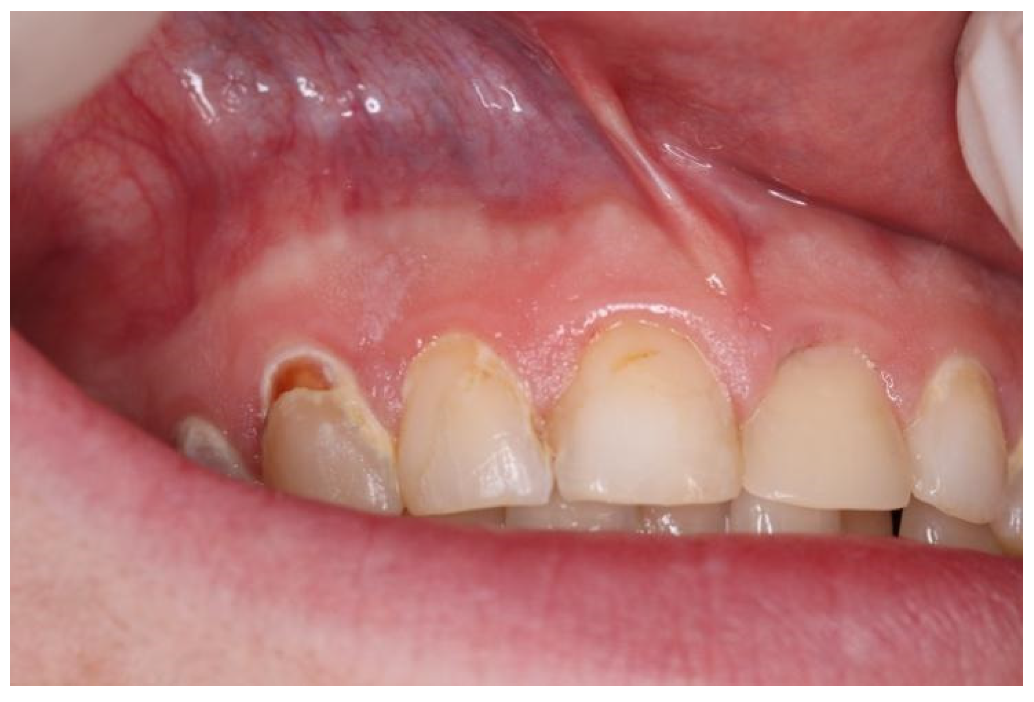 Tobacco keratosis