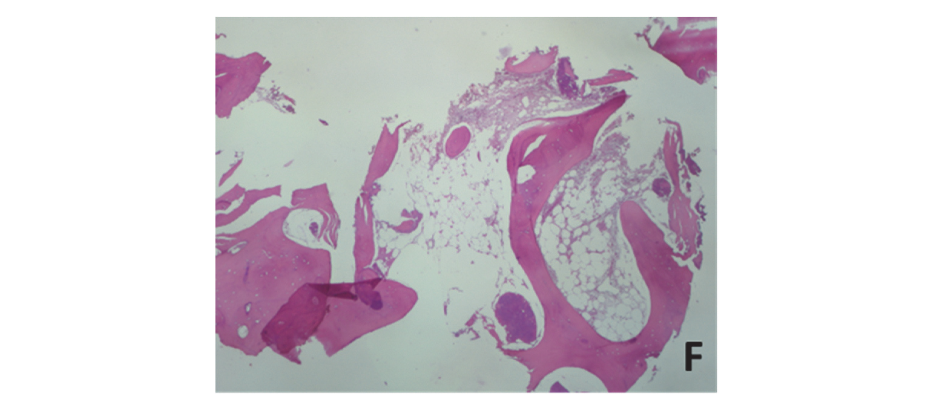 Dentistry Journal Free FullText Peripheral Osteoma of the
