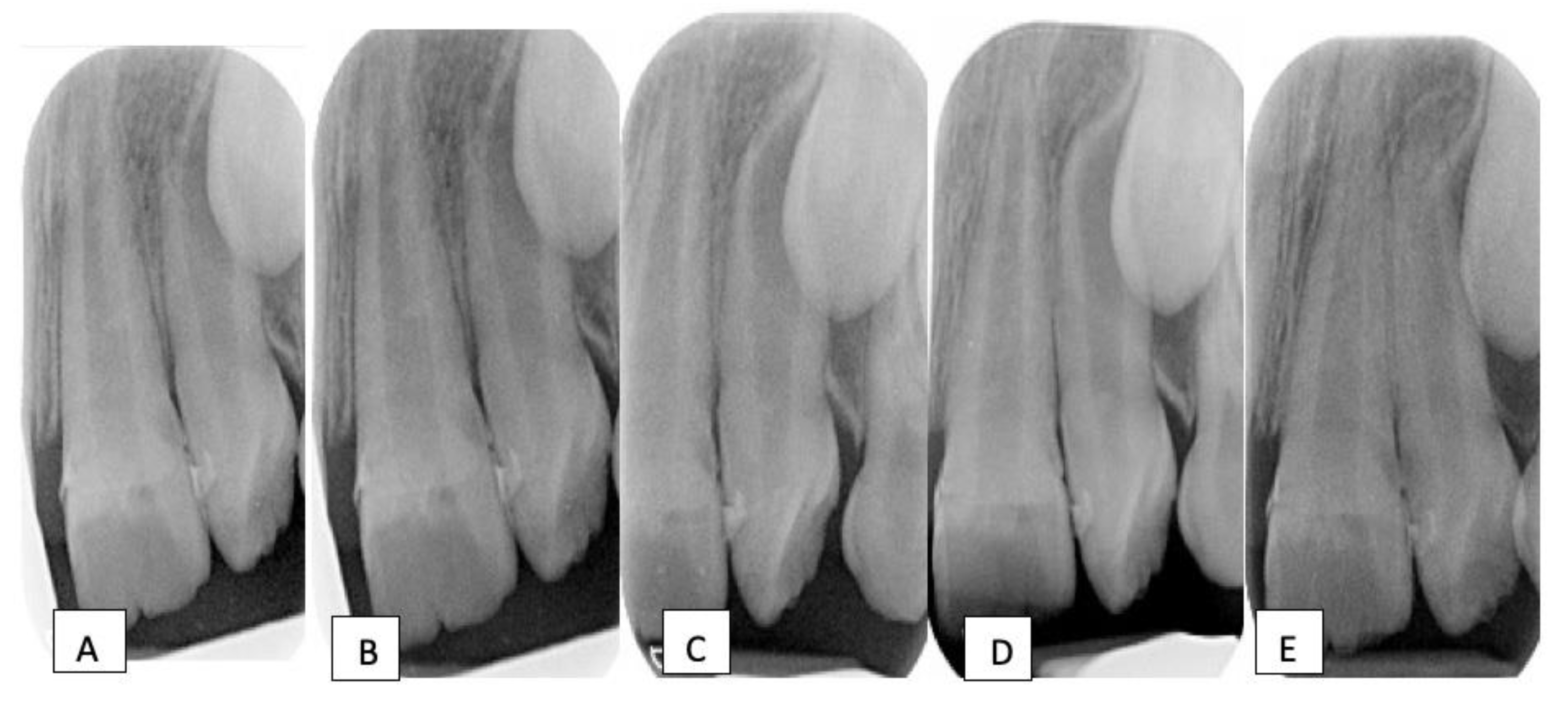 Tooth Intrusion Radiograph