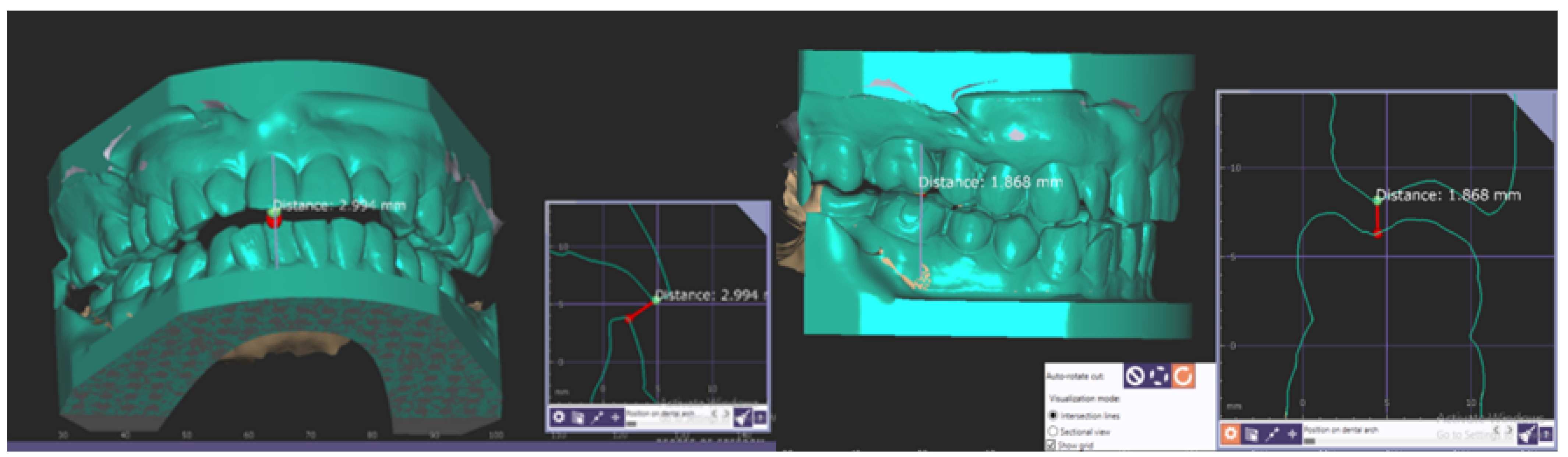Assessment of Occlusal Vertical Dimension Change in Mechanical and ...