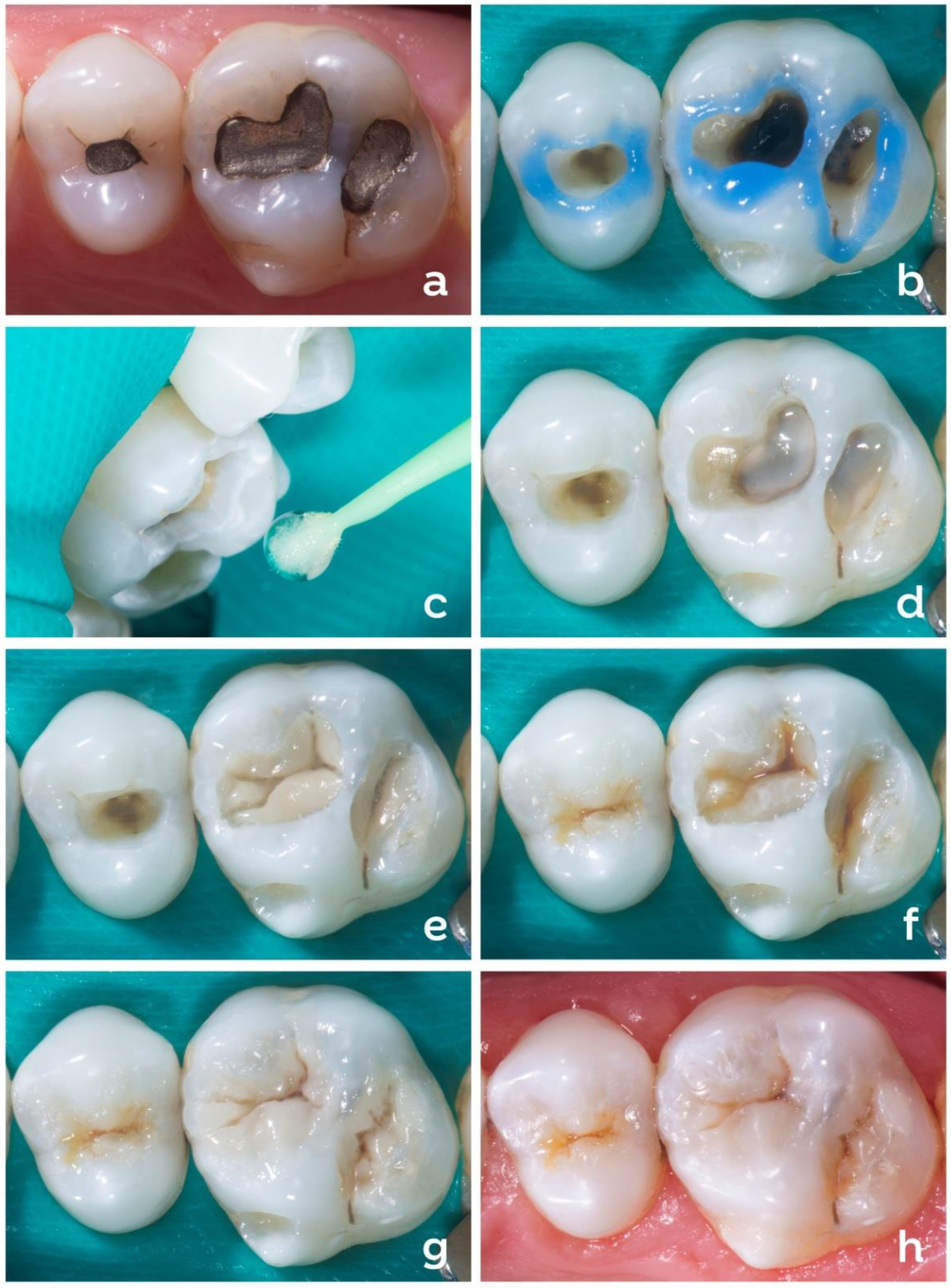 Dentistry 10 00222 g004 Dentistry 10 00222 g004