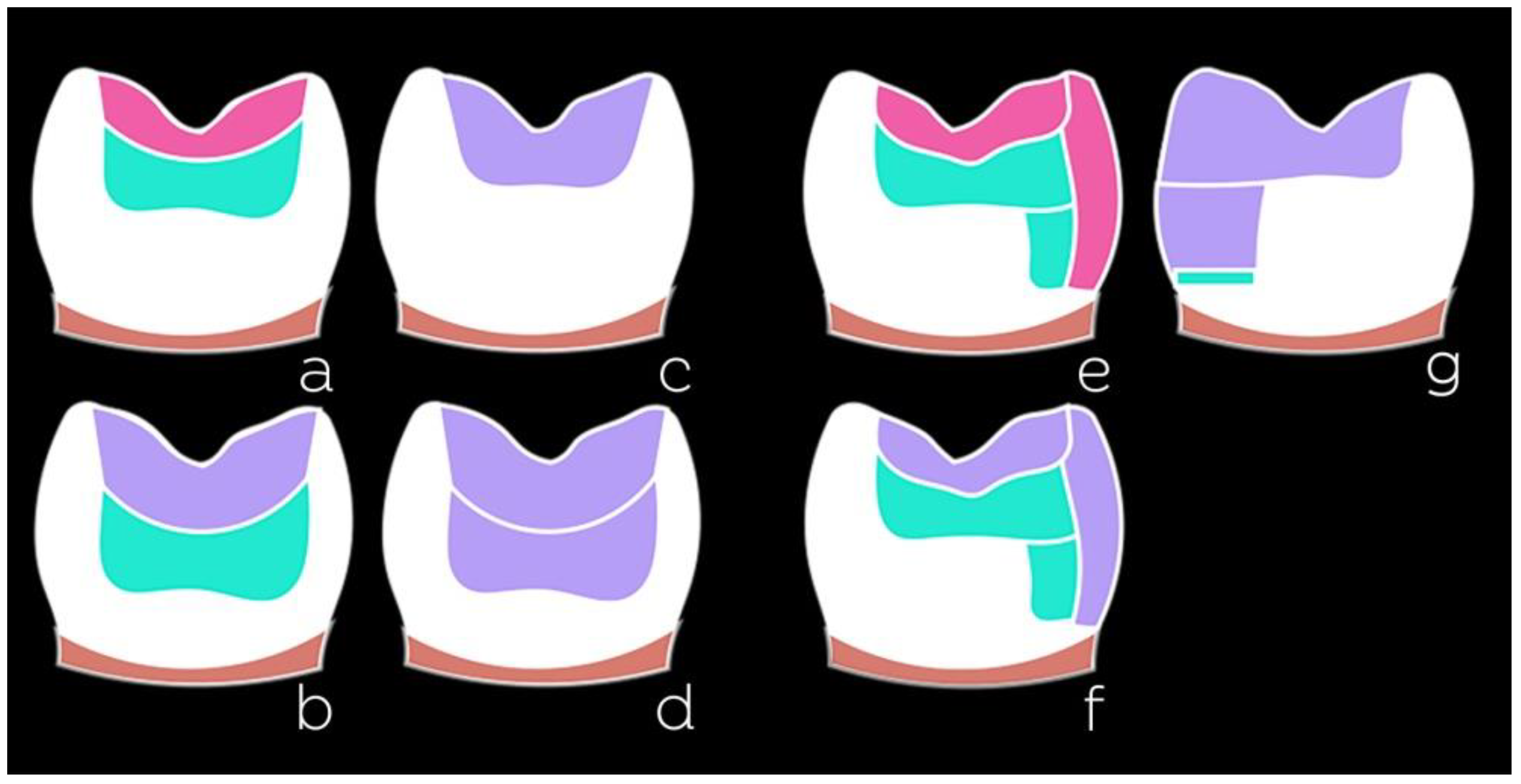 Dentistry Journal Free FullText Resin Composites in Posterior