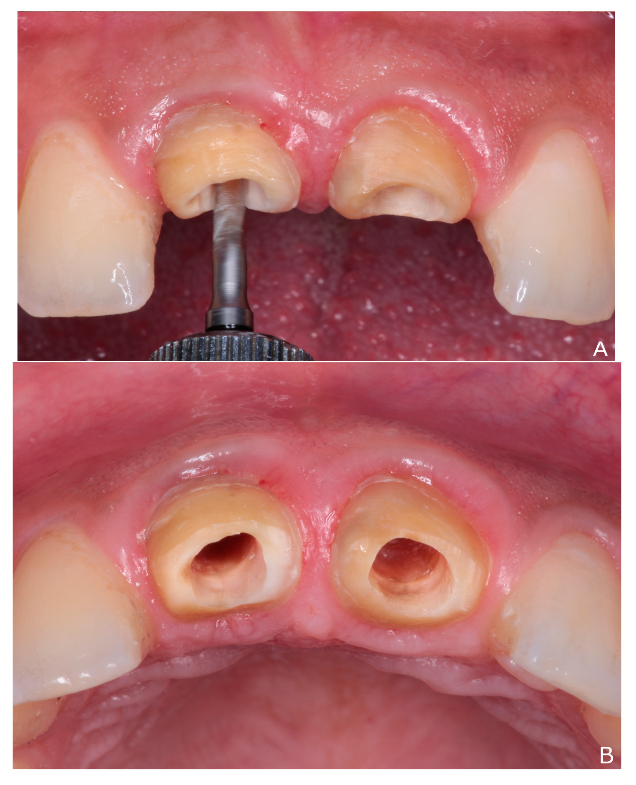 Dentistry 10 00237 g003a Dentistry 10 00237 g003a