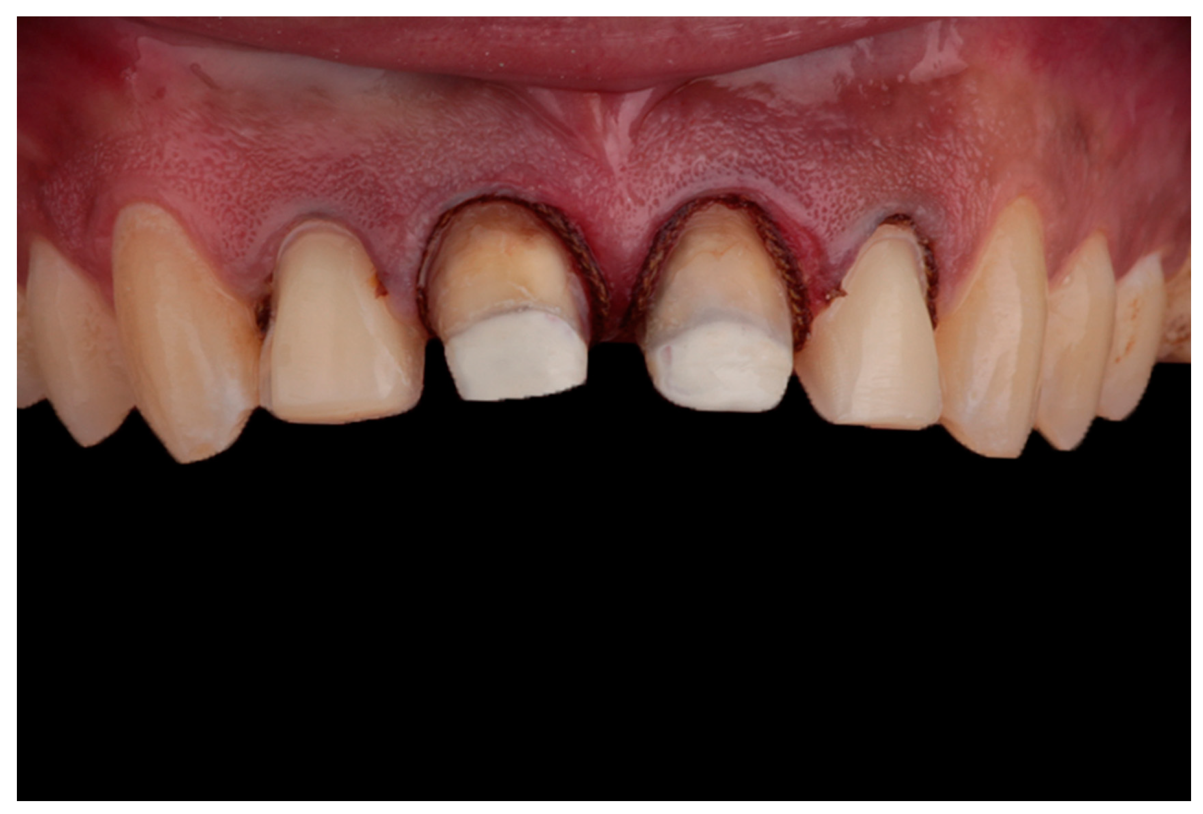 Dentistry Journal Free FullText The Use of Polyetheretherketone