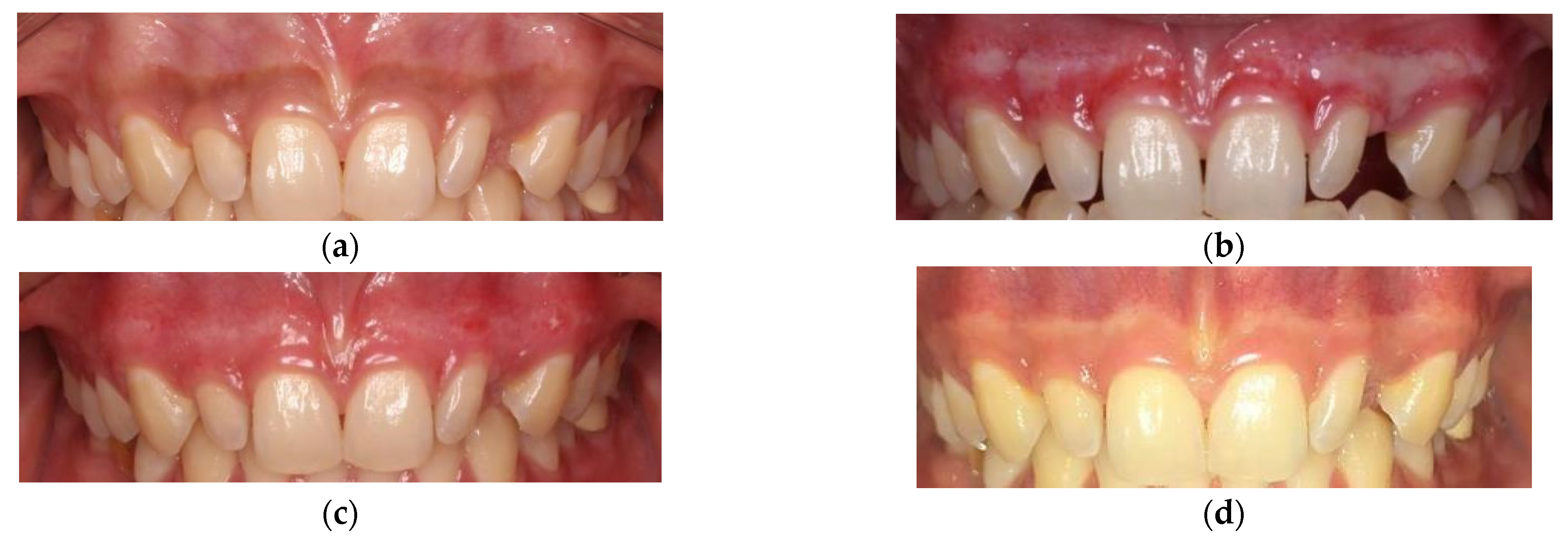 Dentistry Journal Free FullText Evaluation of Carbon Dioxide Laser
