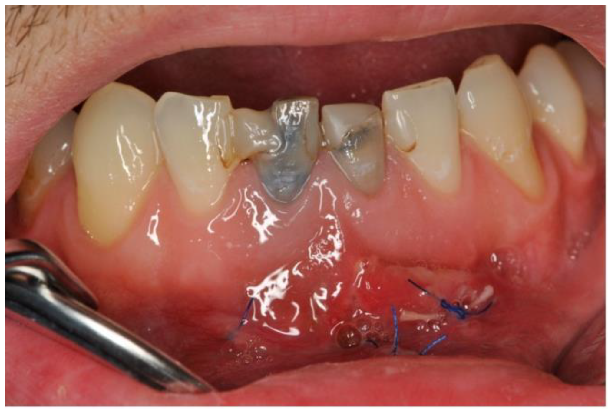 Dentistry 11 00037 g006 Dentistry 11 00037 g006