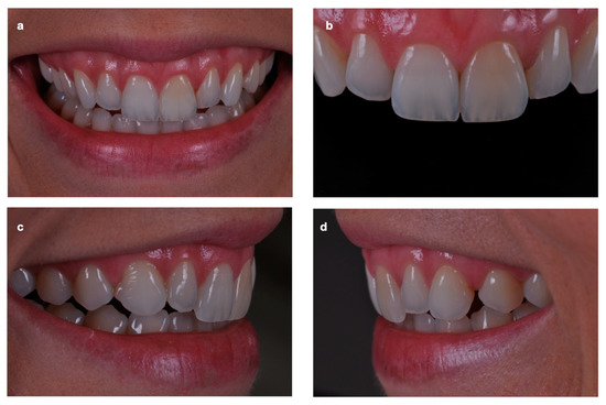 Definitive veneers and crowns prepared digitally using prosthetic