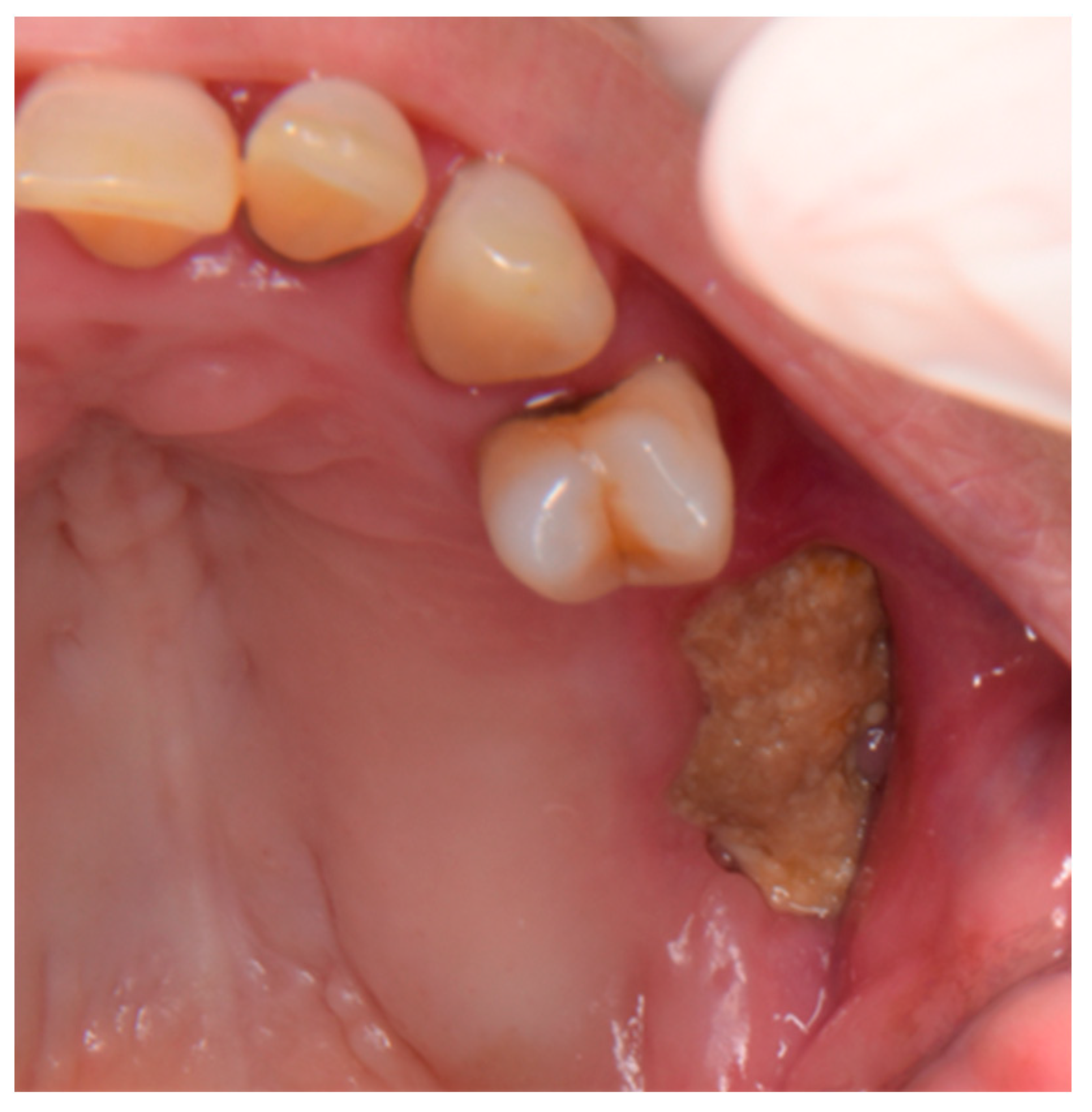 Dentistry Journal | Free Full-Text | Multiple-Drugs-Related Osteonecrosis  of the Jaw in a Patient Affected by Multiple Myeloma: A Case Report