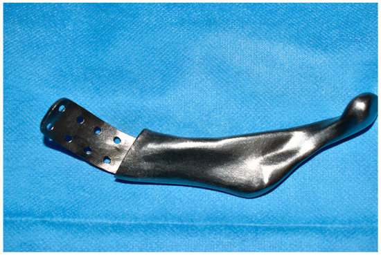 Mandibular Reconstruction after Resection of Ameloblastoma by Custom ...