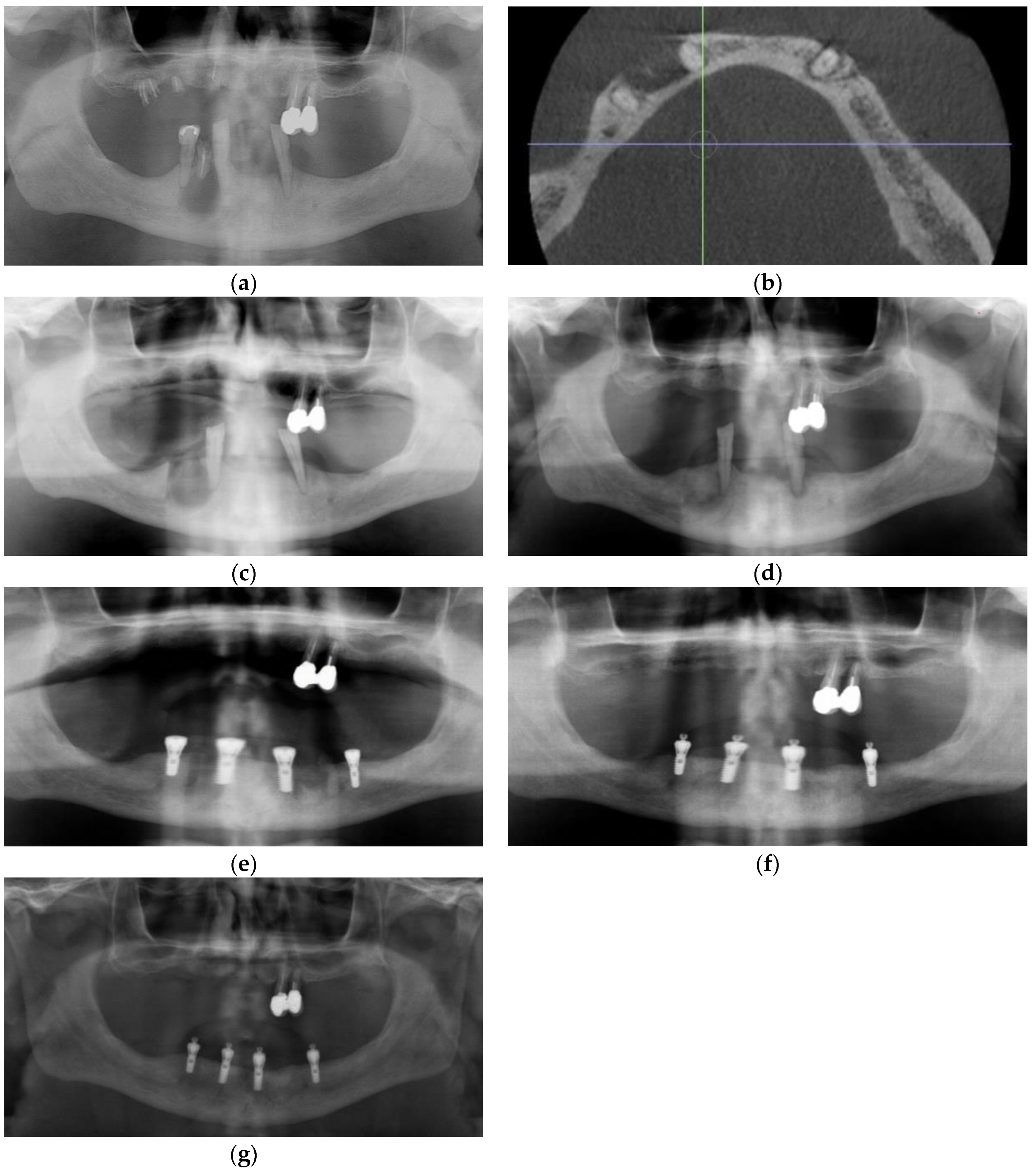 Dentistry 11 00184 g004 Dentistry 11 00184 g004