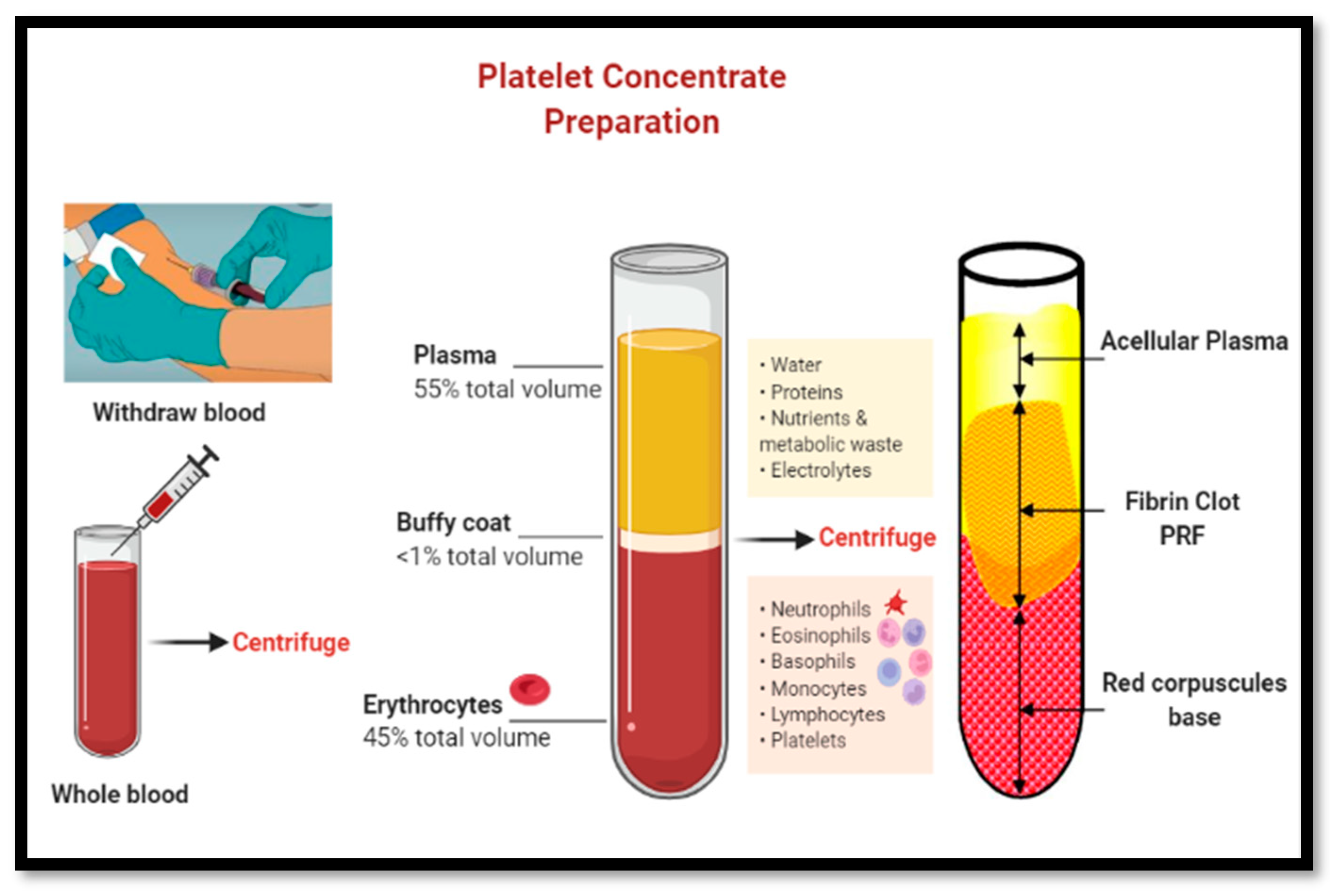 Alveolar Ridge Preservation with Autologous Platelet-Rich Fibrin 