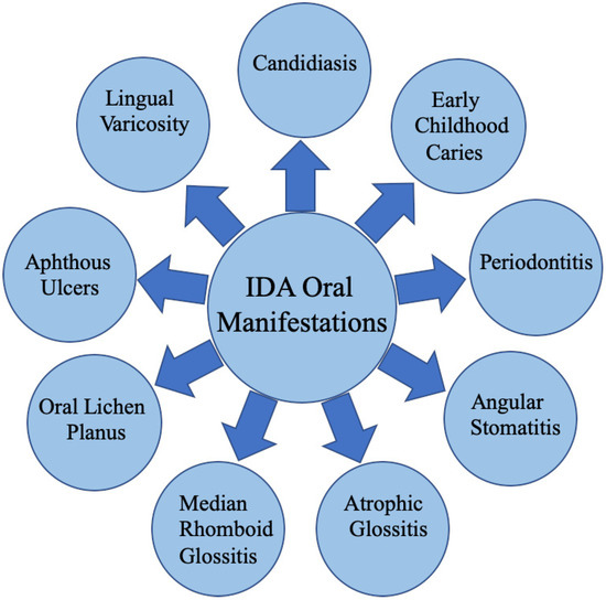 Iron Deficiency Anemia and Its Impact on Oral Health—A 