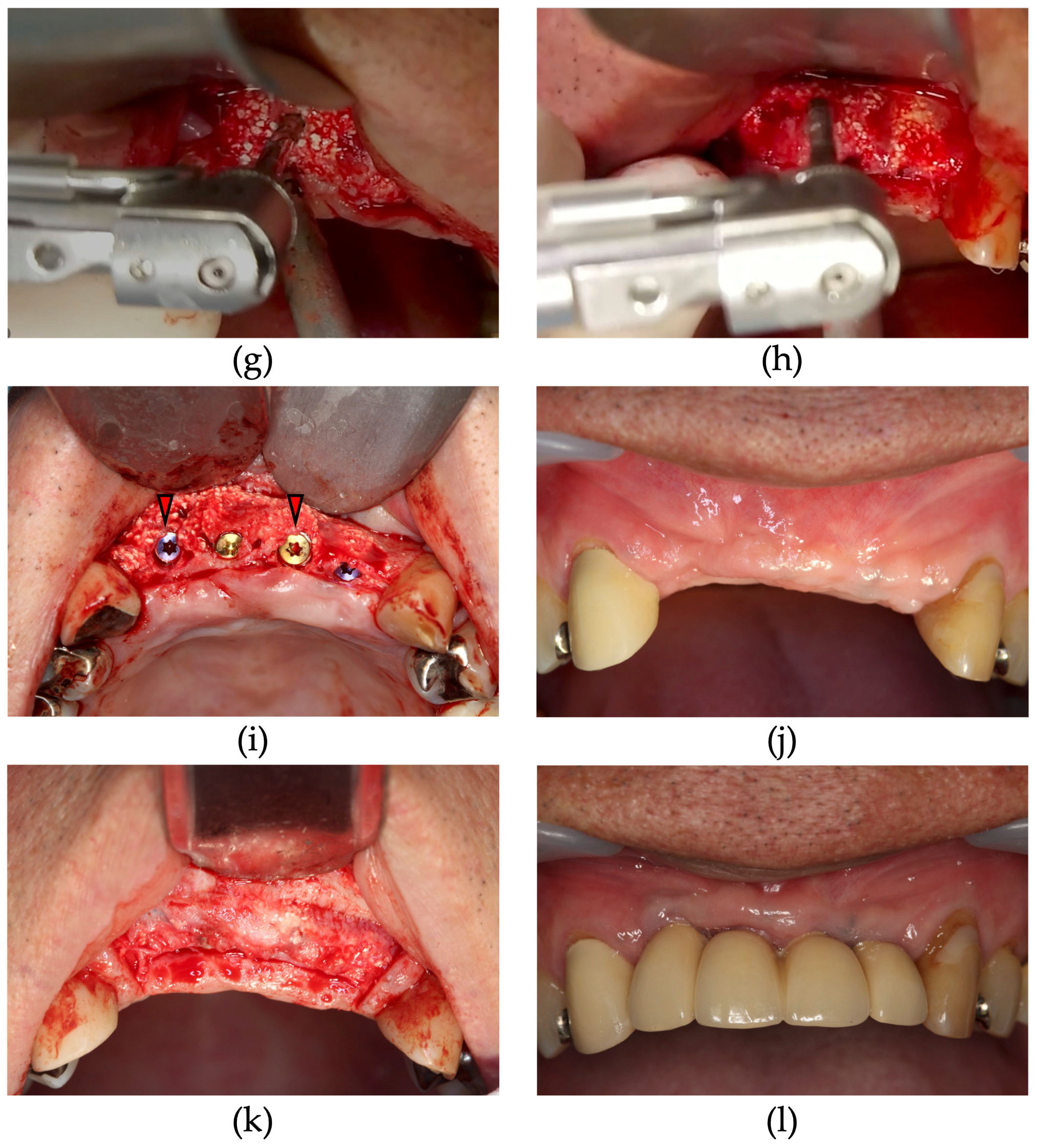 Dentistry 13 00085 g003b