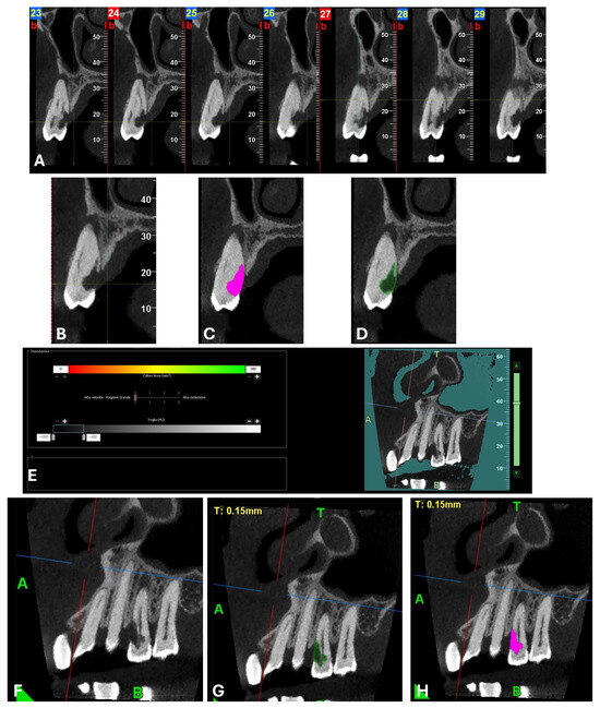 Single-Visit Endodontic Management of a Complex Endo-Periodontal