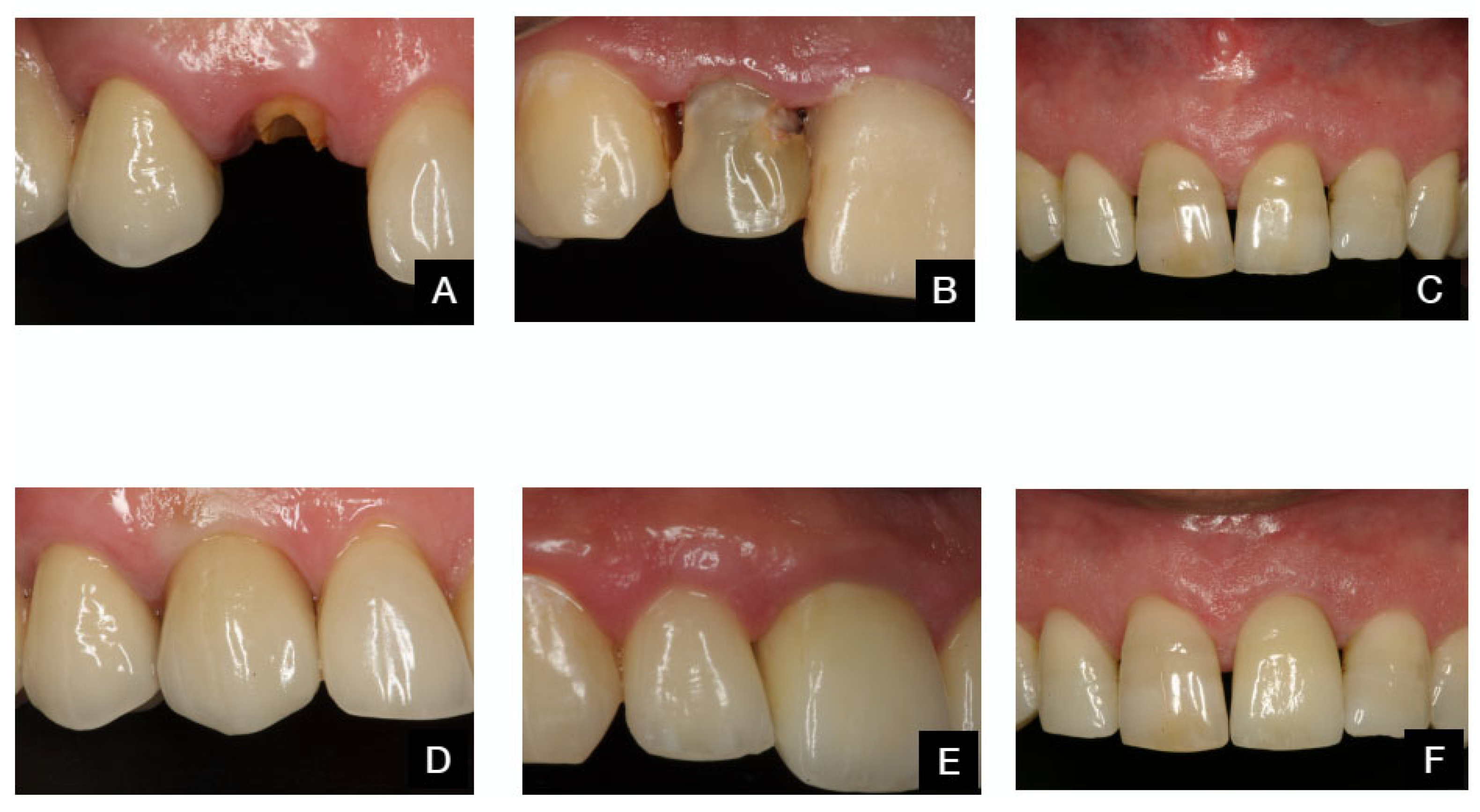 Dentistry 13 00478 g006 Dentistry 13 00478 g006