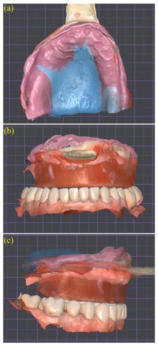 その他 Imai Method Complete Denture Clinical Implementation of a Fully Digital Workflow for the