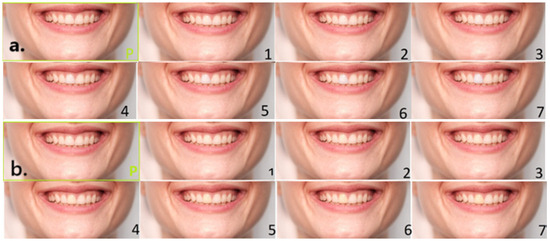 Perceptibility and Acceptability of Tooth and Gingival Shade ...