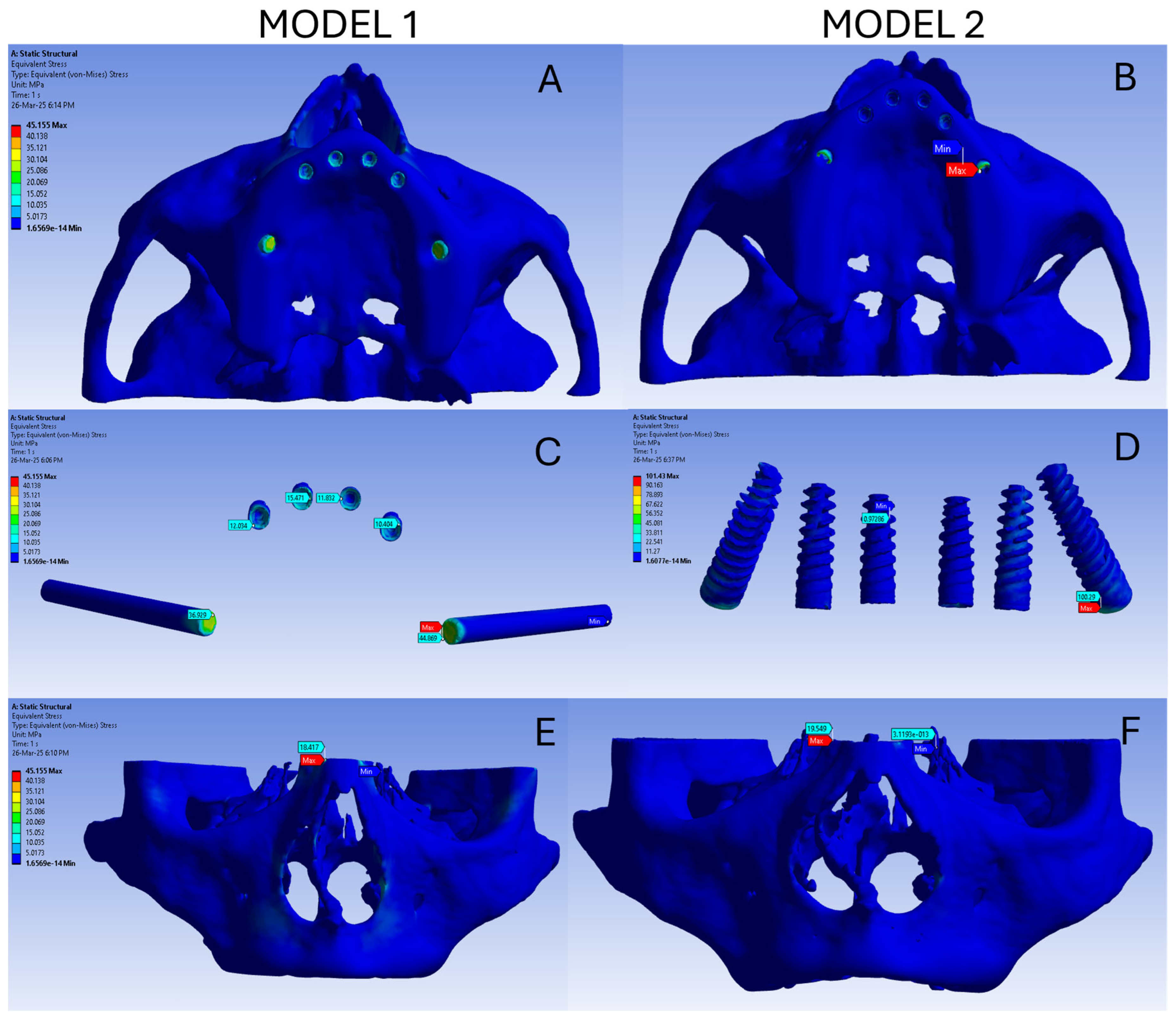 Biomechanical Comparative Evaluation of Atrophic Edentulous