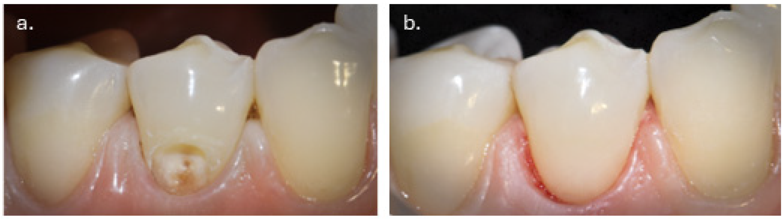 Dentistry 14 00013 g004 Dentistry 14 00013 g004