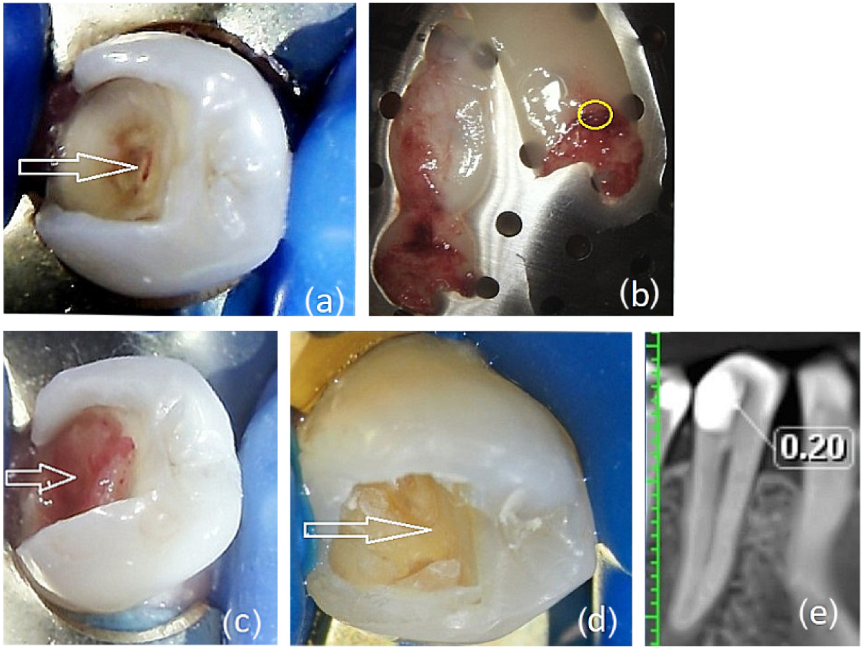 Direct Pulp Capping of Dental Pulp with Two Different Autologous