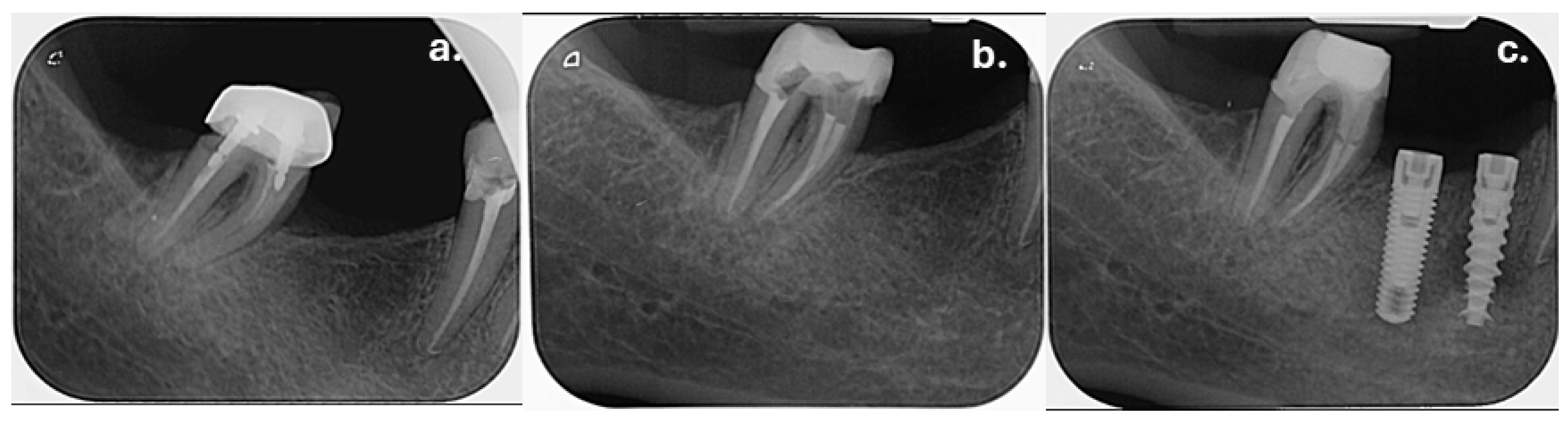 Dentistry 14 00136 g007 Dentistry 14 00136 g007