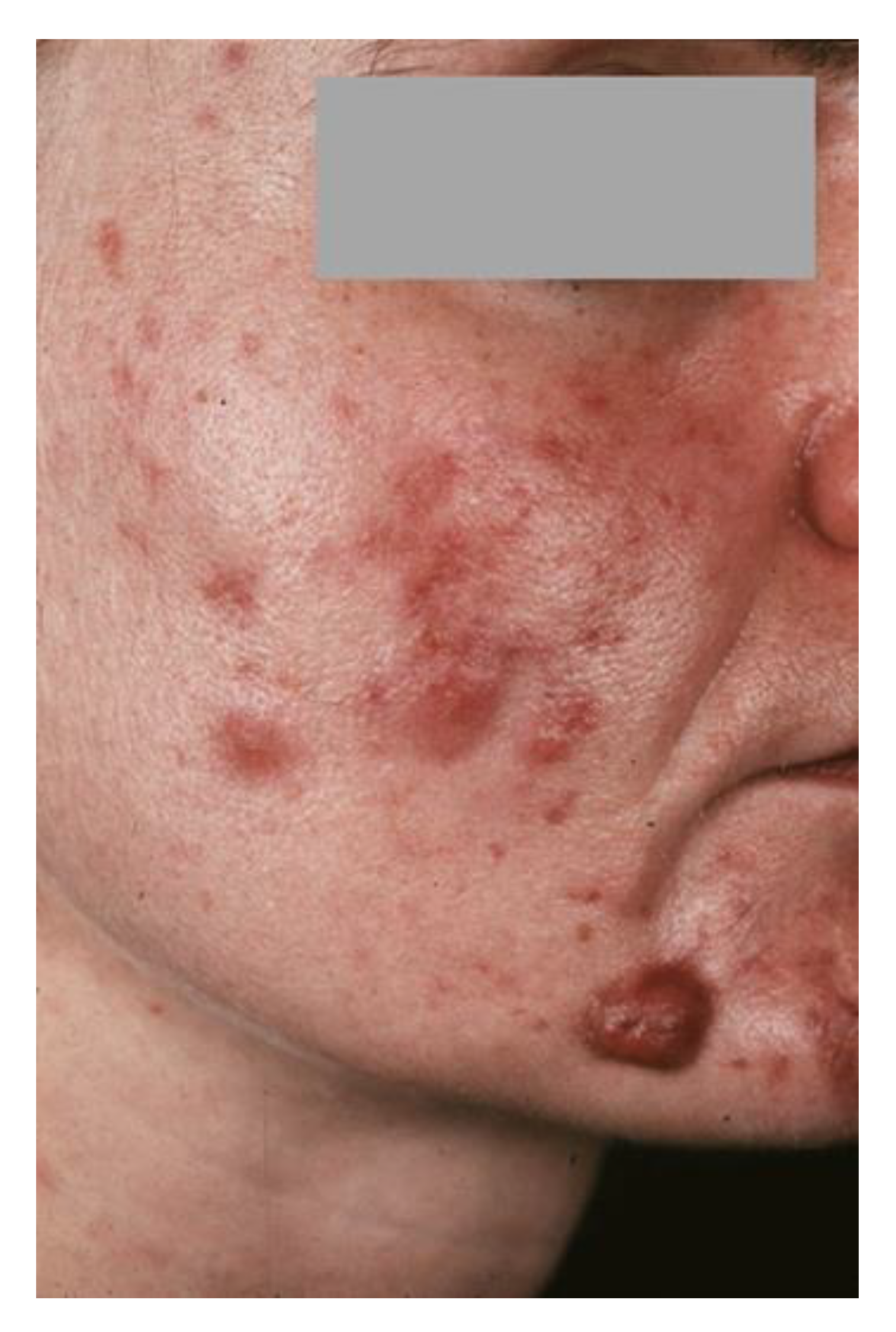 Extreme acne after stopping birth control : r/acne