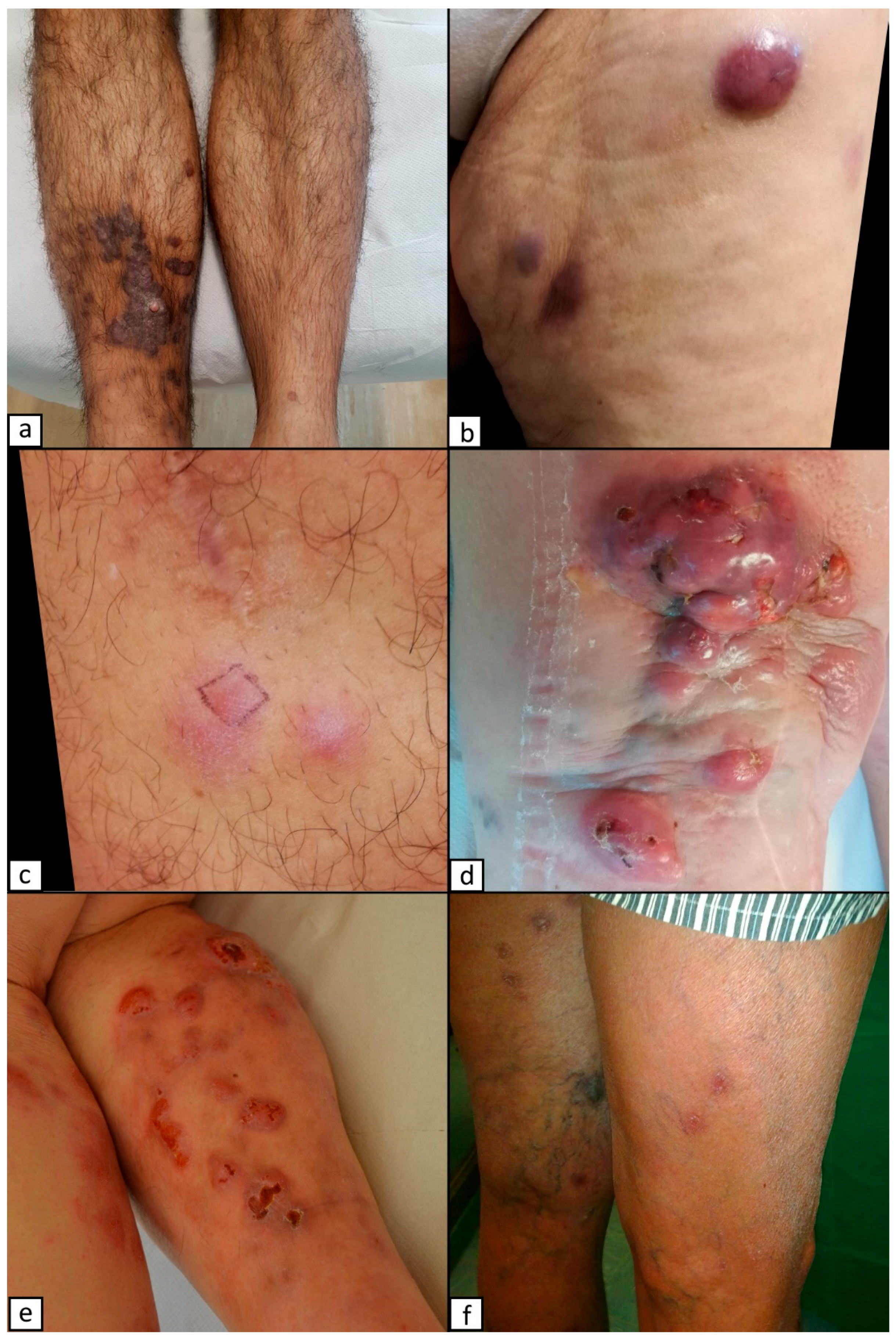 Dermato | Free Full-Text | Violaceous Lesions on the Leg: What Else Apart  from Kaposi Sarcoma? Differential Diagnosis with a Narrative Review of the  Literature