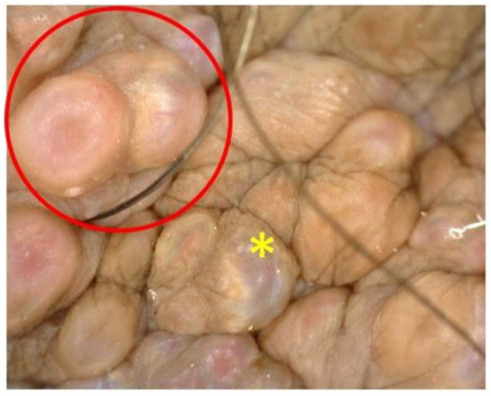 Dermatopathology Free Full Text Scrotal Lymphangiectasia With Penile Elephantiasis In Underlying Lymphatic Filariasis Challenging The Diagnostic Mind A Case Report Html