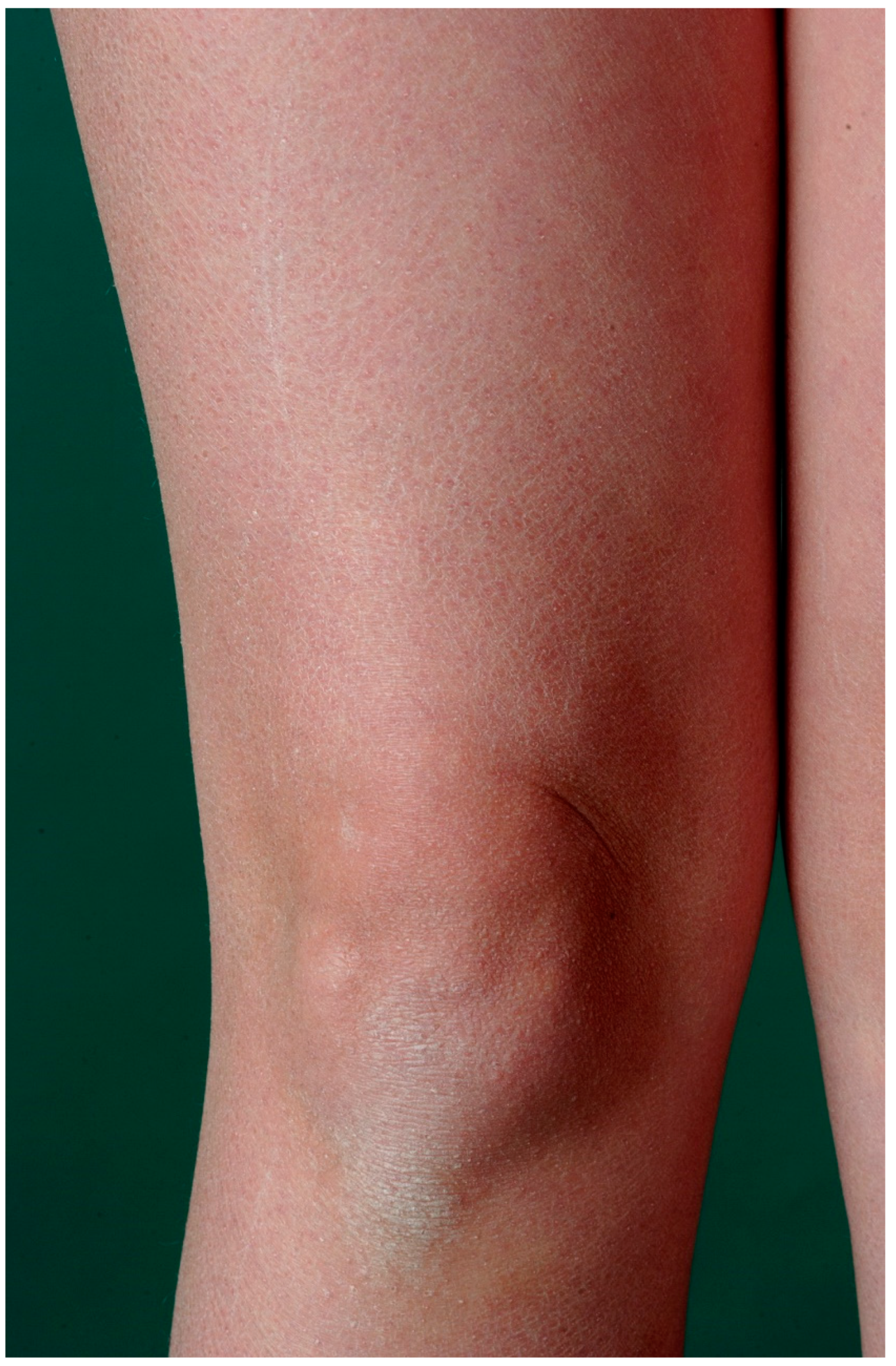 Dermatopathology Free Full Text Ichthyoses A Clinical And Pathological Spectrum From Heterogeneous Cornification Disorders To Inflammation Html