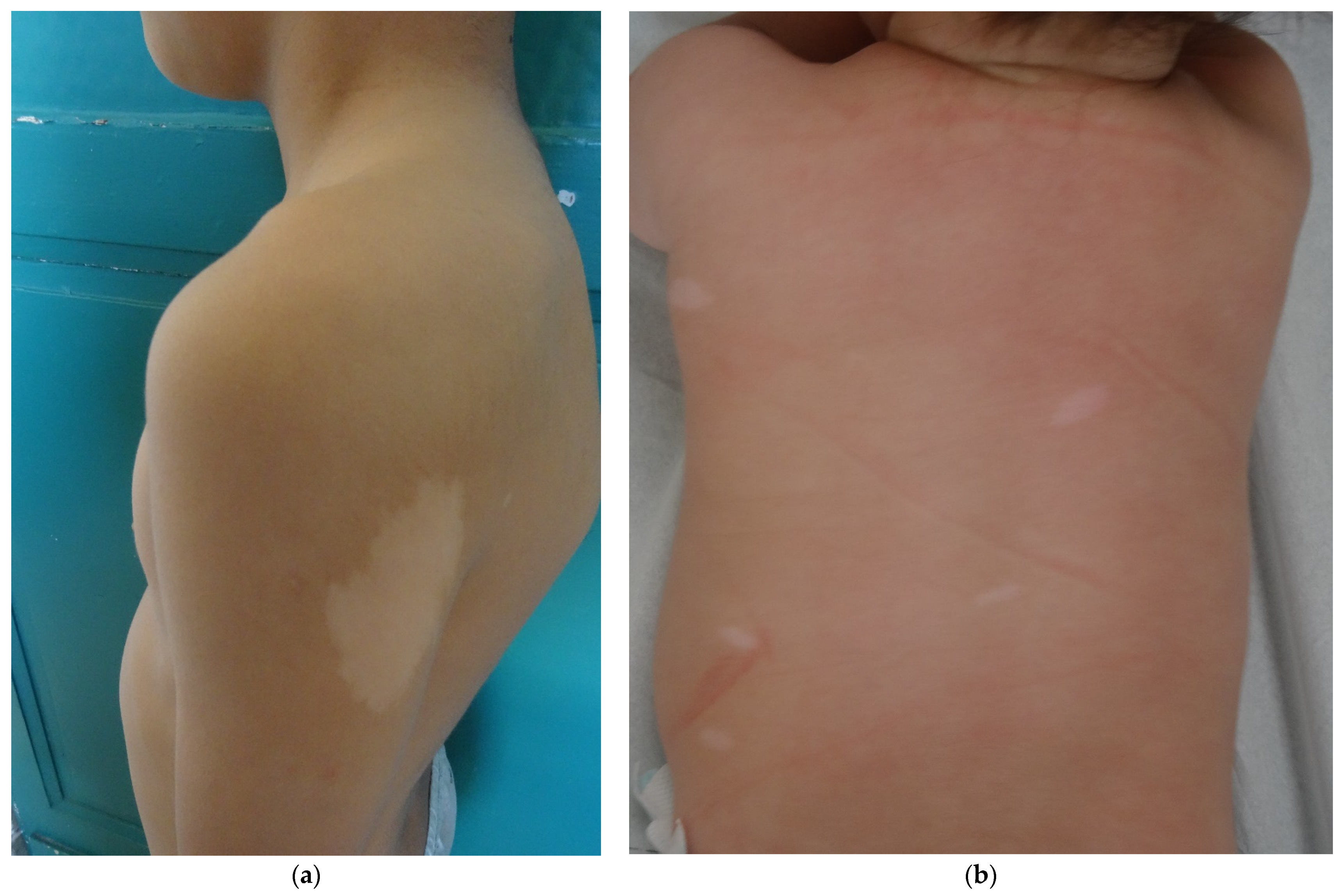 Dermatopathology | Free Full-Text | Histological Patterns of Skin Lesions  in Tuberous Sclerosis Complex: A Panorama