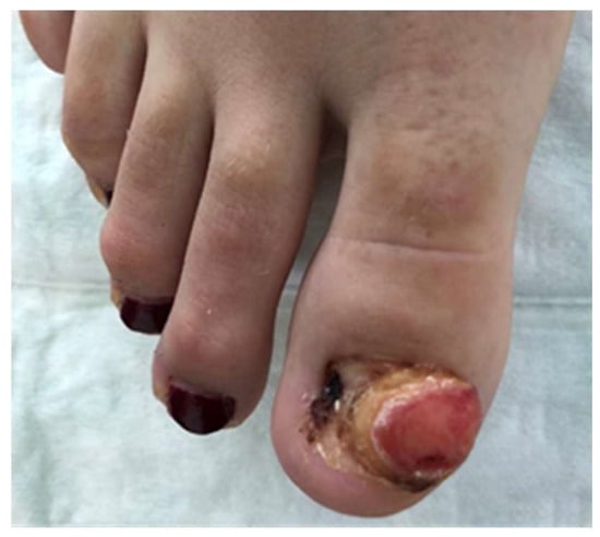 A child with dystrophic changes of the great toenails | Medicine Today