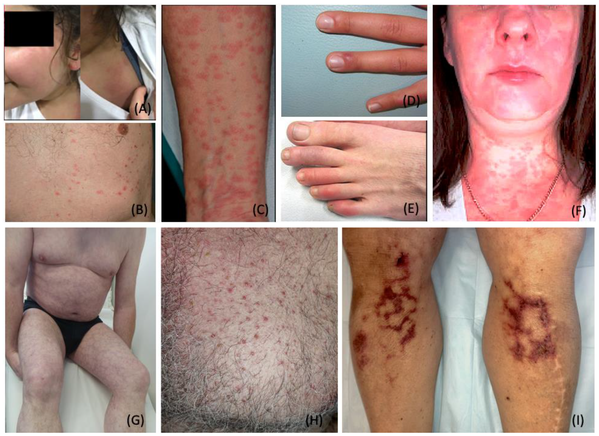 Life Threatening Skin Rash series – Toxic Shock Syndrome - Eczema Blues