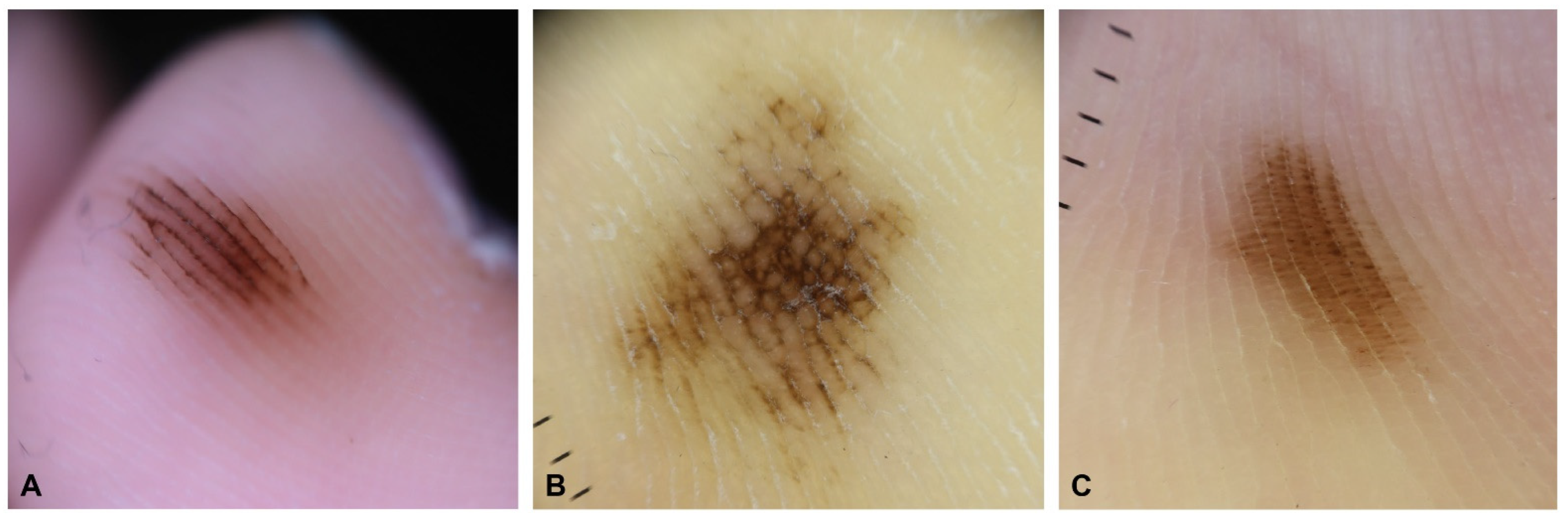 Dermatopathology Free FullText Acral Melanocytic Neoplasms A